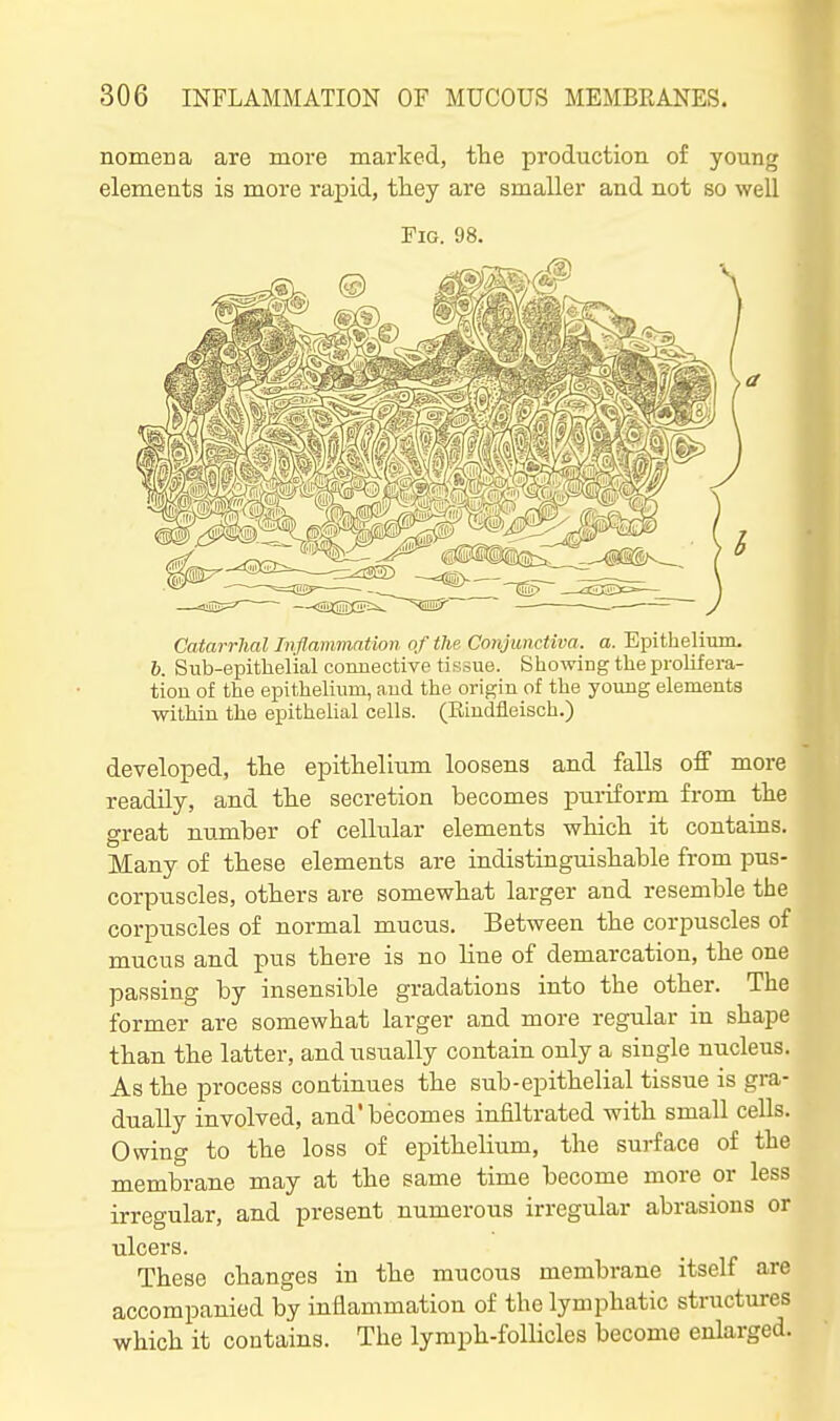 nomena are more marked, the production of young elements is more rapid, they are smaller and not so well Fig. 98. Catarrhal Inflammation of the Conjunctiva, a. Epithelium. b. Sub-epithelial connective tissue. Showing the prolifera- tion of the epithelium, and the origin of the young elements within the epithelial cells. (Eindfleisch.) developed, the epithelium loosens and falls off more readUy, and the secretion becomes puriform from the great number of cellular elements which it contains. Many of these elements are indistinguishable from pus- corpuscles, others are somewhat larger and resemble the corpiiscles of normal mucus. Between the corpuscles of mucus and pus there is no line of demarcation, the one passing by insensible gradations into the other. The former are somewhat larger and more regular in shape than the latter, and usually contain only a single nucleus. As the process continues the sub-epithelial tissue is gra- dually involved, and'becomes infiltrated with small cells. Owing to the loss of epithelium, the surface of the membrane may at the same time become more or less irregular, and present numerous irregular abrasions or ulcers. These changes in the mucous membrane itself are accompanied by inflammation of the lymphatic structures which it contains. The lymph-follicles become enlarged.