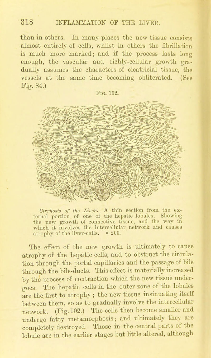 tlian in others. In many places tlie new tissue consists almost entirely of cells, wMlst in otliers the fibrillation is much more marked; and if the process lasts long enough, the vascular and richly-cellular growth gra- dually assumes the characters of cicatricial tissue, the vessels at the same time becoming obliterated. (See Fig. 84.) Fig. 102. Cirrhosis of the Liver. A thin section from the ex- ternal portion of one of the hepatic lobules. Showing the new growth of connective tissue, and the way in which it involves the intercellular network and causes atrophy of the liver-cells, x 200. The effect of the new growth is ultimately to cause atrophy of the hepatic cells, and to obstruct the circula- tion through the portal capillaries and the jjassage of bile through the bile-ducts. This eflfect is materially increased by the process of contraction which the new tissue under- goes. The hepatic cells in the outer zone of the lobules are the first to atrophy ; the new tissue insinuating itself between them, so as to gradually involve the intercellular network. (Fig. 102.) The cells then become smaller and undergo fatty metamorphosis; and ultimately they are completely destroyed. Those in the central parts of the lobule are in the earlier stages but little altered, although