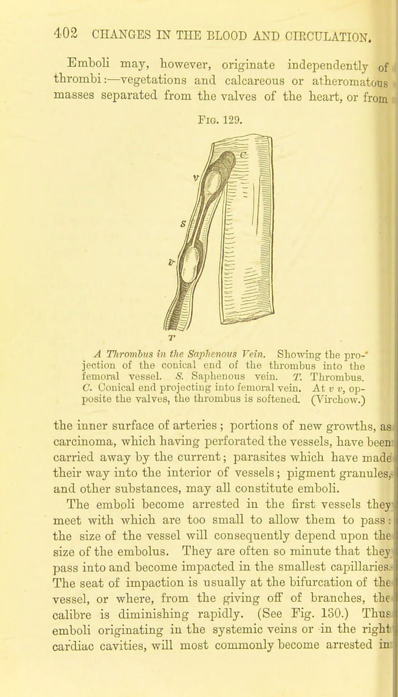 Emboli may, however, originate independently of thrombi:—vegetations and calcareous or atheromatous masses separated from the valves of the heart, or from Fig. 129. r A Tlirombus in the Saplienovs Vein. Showing the pro-' jection of the couical end of the thrombus into the femoral vesseL & Saphenous vein. T. Thrombus. C. Conical end projecting into femoral vein. At v v, opi- posite the valves, the thrombus is softened. (A^chow.) the inner surface of arteries ; portions of new growths, as carcinoma, which having perforated the vessels, have been carried away by the current; parasites which have made their way into the interior of vessels; pigment grannles,- and other substances, may all constitute emboli. The emboli become arrested in the first vessels they meet with which are too small to allow them to pass: the size of the vessel will consequently depend upon the size of the embolus. They are often so minute that they pass into and become impacted in the smallest capillaries.- The seat of impaction is usually at the bifurcation of the vessel, or where, from the giving ofi of branches, the calibre is diminishing rapidly. (See Fig. ISO.) Thus emboli originating in the systemic veins or in the right i cardiac cavities, will most commonly become arrested vsx \ I