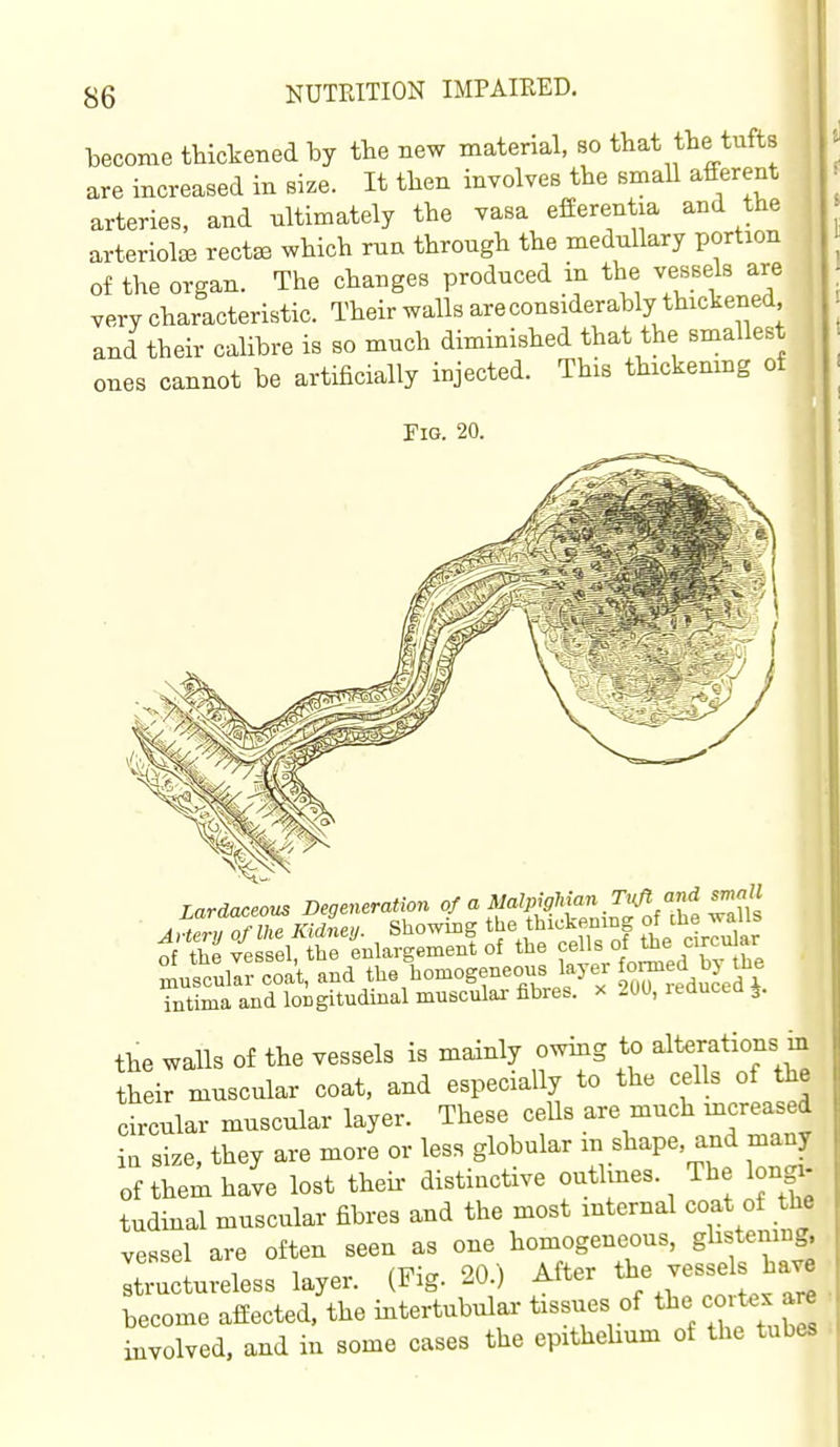 become tMckeiied by the new material, 80 that the tufts are increased in size. It then involves the small afferent arteries, and ultimately the vasa efferentia and the arteriolEB rect^ which ma through the medullary portion of the organ. The changes produced m the vessels are very characteristic. Their walls are considerably thickened and their calibre is so much diminished that the smallest ones cannot be artificially injected. This thickening of Fig. 20. Tardaceous Degeneration of a MalpigMan Tiift and small the walls of the vessels is mainly owing to alterations in their muscular coat, and especially to the cells of the circular muscular layer. These ceUs are much mcreased ia size, they are more or less globular - shape, and j^any of them have lost theh- distiuctive outlmes. The longi- tudinal muscular fibres and the most internal coat of the vessel are often seen as one homogeneous, ghstening. Tuctureless layer. (Fig. 20.) After tbe vessels hav^ become affected, the intertubular tissues of t^e cmte. ar^ involved, and in some cases the epithehum of the tubes