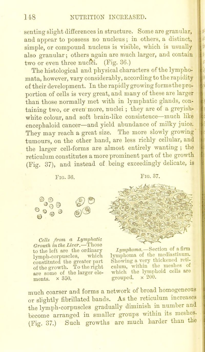 senting slight differences in structure. Some are granular, and appear to possess no nucleus; in others, a distinct, simple, or compound nucleus is visible, which is usually also granular; others again are much larger, and contain two or even three nuclei. (Fig. 36.) The histological and physical characters of the lympho- mata, however, vary considerably, according to the rapidity of their development. In the rapidly growing formsthepro- portion of cells is very great, and many of these are larger than those normally met with in lymphatic glands, con- taining two, or even more, nuclei; they are of a greyish- white colour, and soft brain-like consistence—much like encephaloid cancer—and yield abundance of milky juice. They may reach a great size. The more slowly growing' tumours, on the other hand, are less richly cellular, and the larger cell-forms are almost entirely wanting ; the reticulum constitutes a more prominent part of the growth (Fig. 37), and instead of being exceedingly delicate, is Fig. 36. Fig. 37. ® © © © ^ S) Cells from a LymplmtxG Growth in the Liver.—Those to the left are the ordinary lymph-corpuscles, which constituted the greater part of the growth. To the right are some of the larger ele- ments. X 350. Ljjmphoma. Section of a firm lymphoma of the mediastinuni. Sho^^dng a very thickened reti- culum, within the meshes of which the lymphoid cells are grouped, x 200. much coarser and forms a network of broad homogeneous or slightly fibrillated bands. As the reticulum increases the lymph-corpuscles gradually diminish in number and become arranged in smaller groups within its meshes. (Fig. 37.) Such growths are much harder than the