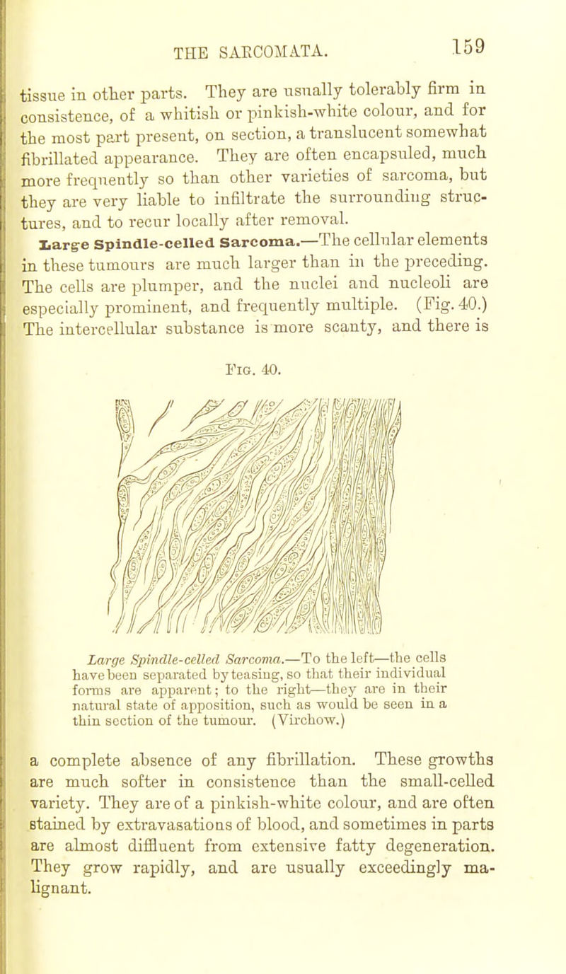 tissue in other parts. They are iisnally tolerably firm in consistence, of a whitish or pinkish-white colour, and for j the most part present, on section, a translucent somewhat fibrillated appearance. They are often encapsuled, much more frequently so than other varieties of sarcoma, but [ they are very liable to infiltrate the surrounding struc- I tures, and to recur locally after removal. Iiarg-e Spindle-celled Sarcoma.—The cellular elements ; in these tumours are much larger than in the preceding. The cells are plumper, and the nuclei and nucleoli are especially prominent, and frequently multiple. (Fig. 40.) The intercellular substance is more scanty, and there is Fm. 40. Large Spindle-celled Sarcoma.—To the loft—the cells have been separated by teasing, so that their individual foi-ms are apparent; to the right—they are in their natural state of apposition, such as would be seen in a thin section of the tumour. (Virohow.) a complete absence of any fibrillation. These growths are much softer in consistence than the small-celled variety. They are of a pinkish-white colour, and are often stained by extravasations of blood, and sometimes in parts are almost diffluent from extensive fatty degeneration. They grow rapidly, and are usually exceedingly ma- lignant.
