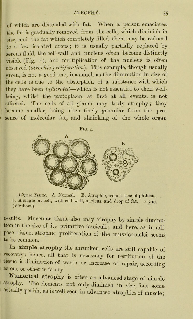 of which are distended with fat. When a person emaciates, the fat is gradually removed from the cells, which diminish in size, and the fat which completely tilled them may be reduced to a few isolated drops; it is usually partially replaced by serous fluid, the cell-wall and nucleus often become distinctly visible (Fig. 4), and multiplication of the nucleus is often observed (atrophic proliferation). This example, though usually given, is not a good one, inasmuch as the diminution in size of the cells is due to the absorption of a substance with which they have been infiltrated—which is not essential to their well- being, whilst the protoplasm, at first at all events, is not affected. The cells of all glands may truly atrophy; they become smaller, being often finely granular from the pre- 1 sence of molecular fat, and shrinking of the whole organ Fig. 4. Adipose Tissue. A. Normal. B. Atrophic, from a case of phthisis, a. A single fat-cell, with cell-wall, nucleus, and drop of fat. x 300. (Virchow.) results. Muscular tissue also may atrophy by simple diminu- tion in the size of its primitive fasciculi; and here, as in adi- pose tissue, atrophic proliferation of the muscle-nuclei seems to be common. In simple atrophy the shrunken cells are still capable of ifcovery; hence, all that is necessary for restitution of the tissue is diminution of waste or increase of repair, according as one or other is faulty. Numerical atrophy is often an advanced stage of simple atrophy. The elements not only diminish in size, hut some actually perish, as is well seen in advanced atrophies of muscle;