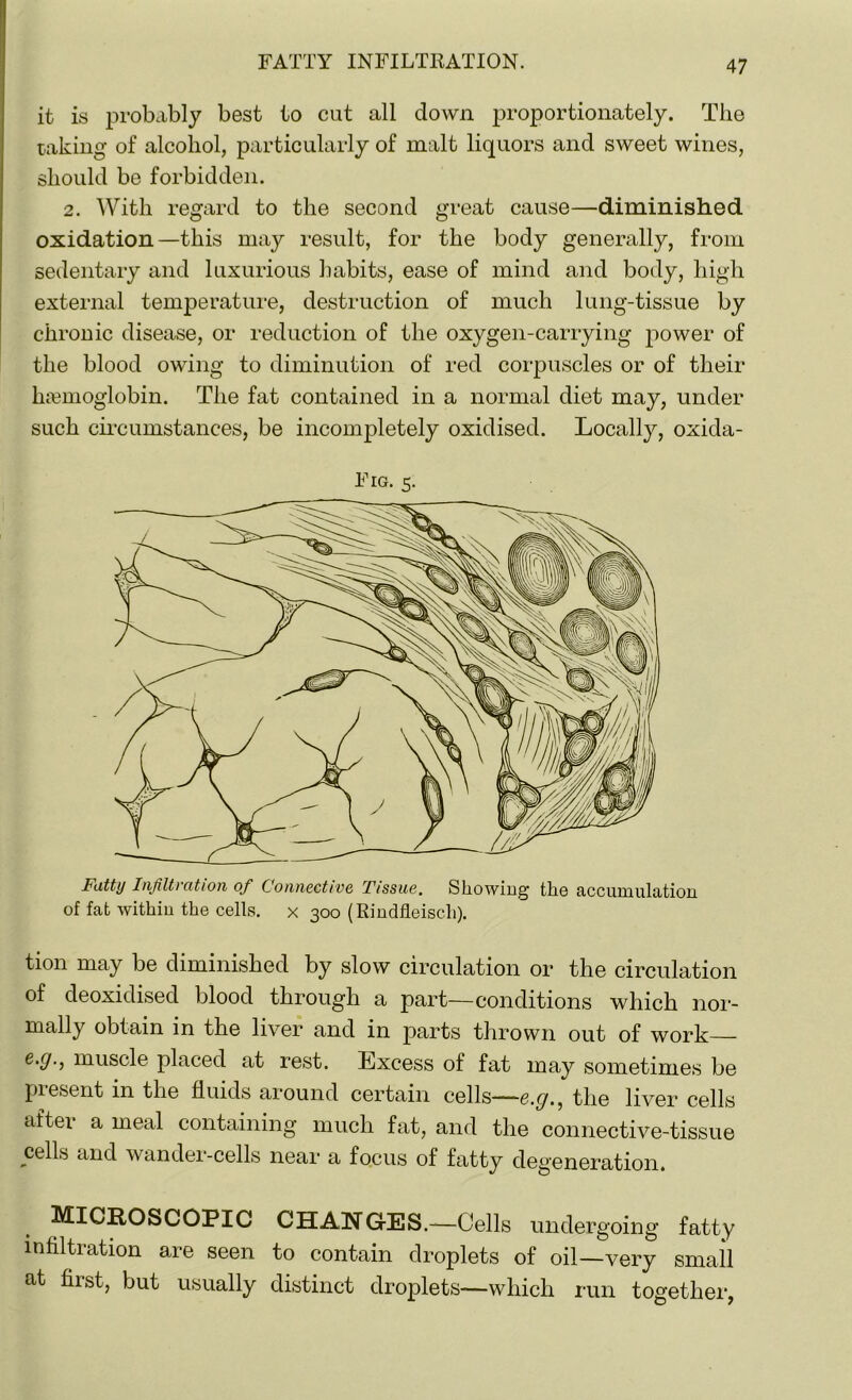 it is probably best to cut all down proportionately. The taking of alcohol, particularly of malt liquors and sweet wines, should be forbidden. 2. With regard to the second great cause—diminished oxidation—this may result, for the body generally, from sedentary and luxurious habits, ease of mind and body, high external temperature, destruction of much lung-tissue by chronic disease, or reduction of the oxygen-carrying power of the blood owing to diminution of red corpuscles or of their lremoglobin. The fat contained in a normal diet may, under such circumstances, be incompletely oxidised. Locally, oxida- Fig. 5. Fatty Infiltration of Connective Tissue. Showing the accumulation of fat within the cells, x 300 (Rindfleisch). tion may be diminished by slow circulation or the circulation of deoxidised blood through a part—conditions which nor- mally obtain in the liver and in parts thrown out of work e.y., muscle placed at rest. Lxcess of fat may sometimes be present in the fluids around certain cells—e.g., the liver cells after a meal containing much fat, and the connective-tissue cells and wander-cells near a focus of fatty degeneration. MICROSCOPIC CHANGES.—Cells undergoing fatty infiltration are seen to contain droplets of oil—very small at first, but usually distinct droplets—which run together,