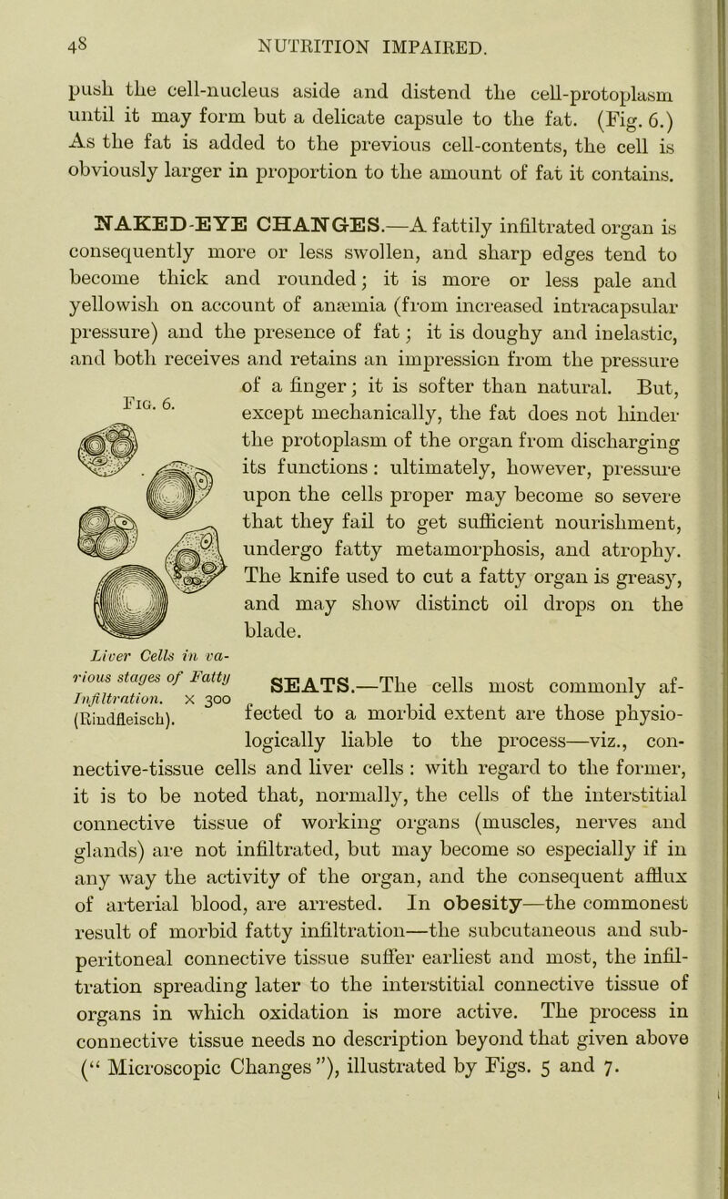 push, the cell-nucleus aside and distend the cell-protoplasm until it may form but a delicate capsule to the fat. (Fig. 6.) As the fat is added to the previous cell-contents, the cell is obviously larger in proportion to the amount of fat it contains. NAKED-EYE CHANGES.—A fattily infiltrated organ is consequently more or less swollen, and sharp edges tend to become thick and rounded; it is more or less pale and yellowish on account of anaemia (from increased intracapsular pressure) and the presence of fat; it is doughy and inelastic, and both receives and retains an impression from the pressure of a finger; it is softer than natural. But, except mechanically, the fat does not hinder the protoplasm of the organ from discharging its functions : ultimately, however, pressure upon the cells proper may become so severe that they fail to get sufficient nourishment, undergo fatty metamorphosis, and atrophy. The knife used to cut a fatty organ is greasy, and may show distinct oil drops on the blade. SEATS.—The cells most commonly af- fected to a morbid extent are those physio- logically liable to the process—viz., con- nective-tissue cells and liver cells : with regard to the former, it is to be noted that, normally, the cells of the interstitial connective tissue of working organs (muscles, nerves and glands) are not infiltrated, but may become so especially if in any way the activity of the organ, and the consequent afflux of arterial blood, are arrested. In obesity—the commonest result of morbid fatty infiltration—the subcutaneous and sub- peritoneal connective tissue suffer earliest and most, the infil- tration spreading later to the interstitial connective tissue of organs in which oxidation is more active. The process in connective tissue needs no description beyond that given above (“ Microscopic Changes”), illustrated by Figs. 5 and 7. Eig. 6. Liver Cells in va- rious stages of Fatty Infiltration, x 300 (Rindfleiscli).