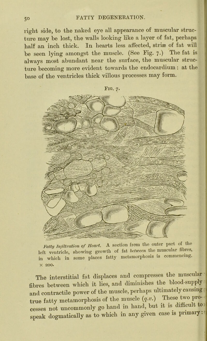 right side, to the naked eye all appearance of muscular struc- ture may be lost, the walls looking like a layer of fat, perhaps half an inch thick. In hearts less affected, striae of fat will be seen lying amongst the muscle. (See Fig. 7.) The fat is always most abundant near the surface, the muscular struc- ture becoming more evident towards the endocardium.: at the base of the ventricles thick villous processes may form. Fig. 7. Fatty Infiltration of Heart. A section from the outer part of the left ventricle, showing growth of fat between the muscular fibres, in which in some places fatty metamorphosis is commencing. x 200. The interstitial fat displaces and compresses the muscular fibres between which it lies, and diminishes the blood-supply and contractile power of the muscle, perhaps ultimately causing true fatty metamorphosis of the muscle (q.v.) These two pro- cesses not uncommonly go hand in hand, but it is difficult to speak dogmatically as to which in any given case is primary: