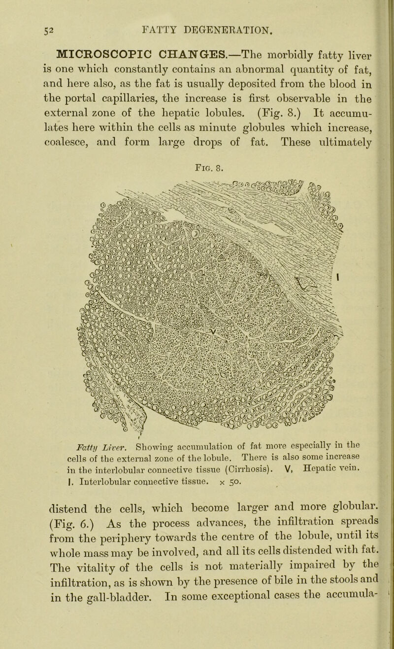 MICROSCOPIC CHANGES.—The morbidly fatty liver is one which constantly contains an abnormal quantity of fat, and here also, as the fat is usually deposited from the blood in the portal capillaries, the increase is first observable in the external zone of the hepatic lobules. (Fig. 8.) It accumu- lates here within the cells as minute globules which increase, coalesce, and form large drops of fat. These ultimately Fig. 8. Fatty Liver. Showing accumulation of fat moi'e especially in the cells of the external zone of the lobule. There is also some increase in the interlobular connective tissue (Cirrhosis). V, Hepatic vein. I. Interlobular connective tissue, x 50. distend the cells, which become larger and more globular. (Fig. 6.) As the process advances, the infiltration spreads from the periphery towards the centre of the lobule, until its whole mass may be involved, and all its cells distended with fat. The vitality of the cells is not materially impaired by the infiltration, as is shown by the presence of bile in the stools and in the gall-bladder. In some exceptional cases the accumula-
