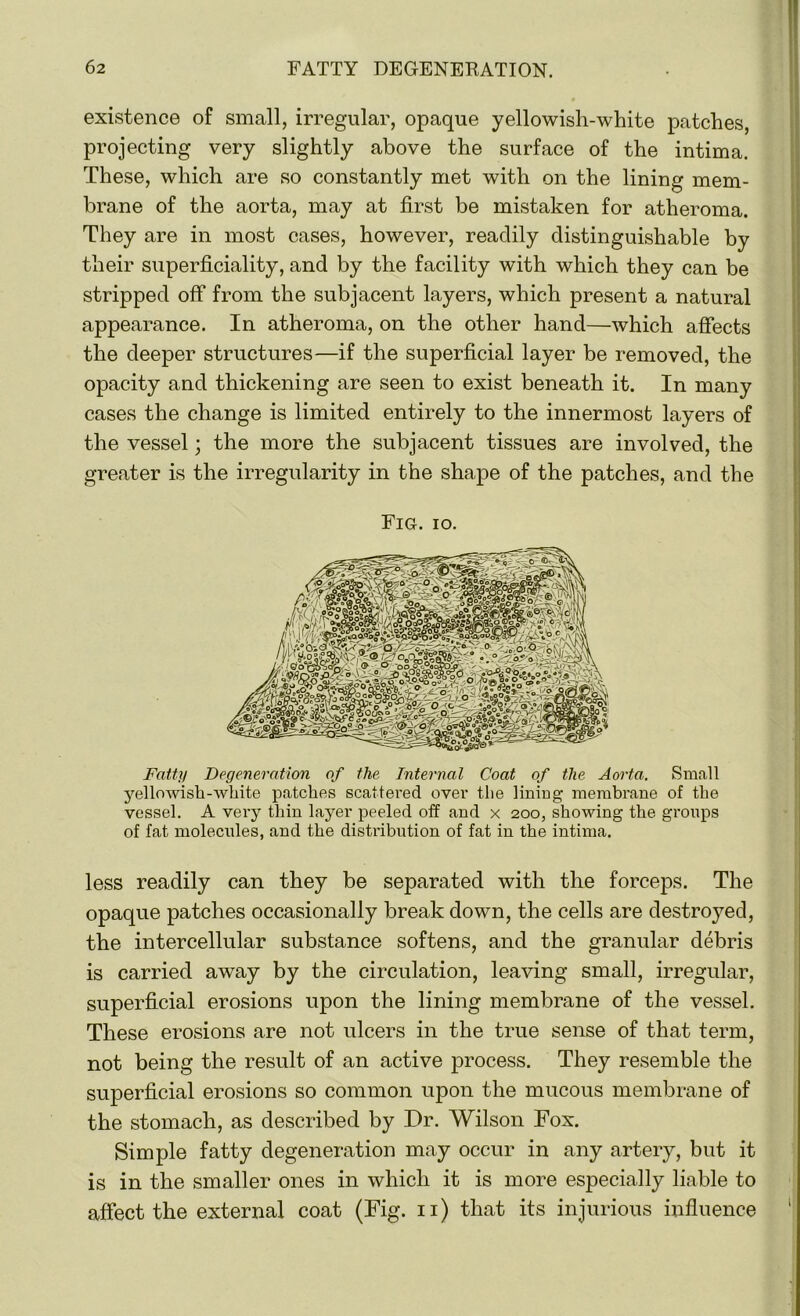 existence of small, irregular, opaque yellowish-white patches, projecting very slightly above the surface of the intima. These, which are so constantly met with on the lining mem- brane of the aorta, may at first be mistaken for atheroma. They are in most cases, however, readily distinguishable by their superficiality, and by the facility with which they can be stripped off from the subjacent layers, which present a natural appearance. In atheroma, on the other hand—which affects the deeper structures—if the superficial layer be removed, the opacity and thickening are seen to exist beneath it. In many cases the change is limited entirely to the innermost layers of the vessel; the more the subjacent tissues are involved, the greater is the irregularity in the shape of the patches, and the Fig. io. Fatty Degeneration of the Internal Coat of the Aorta. Small yellowish-white patches scattered over the lining membrane of the vessel. A vei'y thin layer peeled off and x 200, showing the groups of fat molecules, and the distribution of fat in the intima. less readily can they be separated with the forceps. The opaque patches occasionally break down, the cells are destroyed, the intercellular substance softens, and the granular debris is carried away by the circulation, leaving small, irregular, superficial erosions upon the lining membrane of the vessel. These erosions are not ulcers in the true sense of that term, not being the result of an active process. They resemble the superficial erosions so common upon the mucous membrane of the stomach, as described by Dr. Wilson Fox. Simple fatty degeneration may occur in any artery, but it is in the smaller ones in which it is more especially liable to affect the external coat (Fig. 11) that its injurious influence l