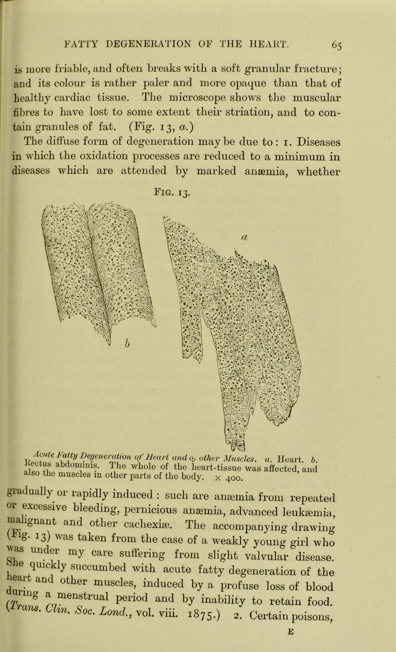is more friable, and often breaks witli a soft granular fracture; and its colour is rather paler and more opaque than that of healthy cardiac tissue. The microscope shows the muscular fibres to have lost to some extent their striation, and to con- tain granules of fat. (Fig. 13, a.) The diffuse form of degeneration may be due to : 1. Diseases in which the oxidation processes are reduced to a minimum in diseases which are attended by marked anaemia, whether I tsf '%* gjrftef ii Acute tatty Degeneration of Heart and Oj other Muscles, a. Heart b Rectus abdominis. The whole of the heart-tissue was affected, and also the muscles in other parts of the body, x 400. gradually 01 rapidly induced : such are antenna from repeated or excessive bleeding, pernicious anaemia, advanced leukaemia, ma ignant and other cachexite. The accompanying drawing vJHg. 13) was taken from the case of a weakly young girl who jvas under my care suffering from slight valvular disease, e quickly succumbed with acute fatty degeneration of the eai and other muscles, induced by a profuse loss of blood mvZ ^7men<frUal period and inability to retain food. • Clm. £>oc. Lond., vol. viii. 1875.) 2. Certain poisons, E