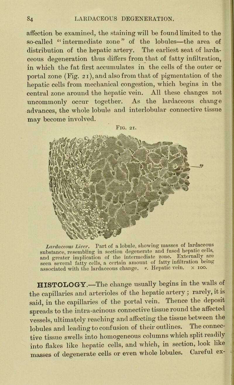 affection be examined, the staining will be found limited to the so-called “intermediate zone” of the lobules—the area of distribution of the hepatic artery. The earliest seat of larda- ceous degeneration thus differs from that of fatty infiltration, in which the fat first accumulates in the cells of the outer or portal zone (Fig. 21), and also from that of pigmentation of the hepatic cells from mechanical congestion, which begins in the central zone around the hepatic vein. All these changes not uncommonly occur together. As the lardaceous change advances, the whole lobule and interlobular connective tissue may become involved. Fig. 21. Lardaceous Liver. Part of a lobule, showing masses of lardaceous substance, resembling in section degenerate and fused hepatic cells, and greater implication of the intermediate zone. Externally aie seen several fatty cells, a certain amount of fatty infiltration being associated with the lardaceous change, v. Hepatic vein, x 100. HISTOLOGY.—The change usually begins in the walls of the capillaries and arterioles of the hepatic artery ; rarely, it is said, in the capillaries of the portal vein. Thence the deposit spreads to the intra-acinous connective tissue round the affected vessels, ultimately reaching and affecting the tissue between the lobules and leading to confusion of their outlines. The connec- tive tissue swells into homogeneous columns which split readily into flakes like hepatic cells, and which, in section, look like masses of degenerate cells or even whole lobules. Careful ex- 1