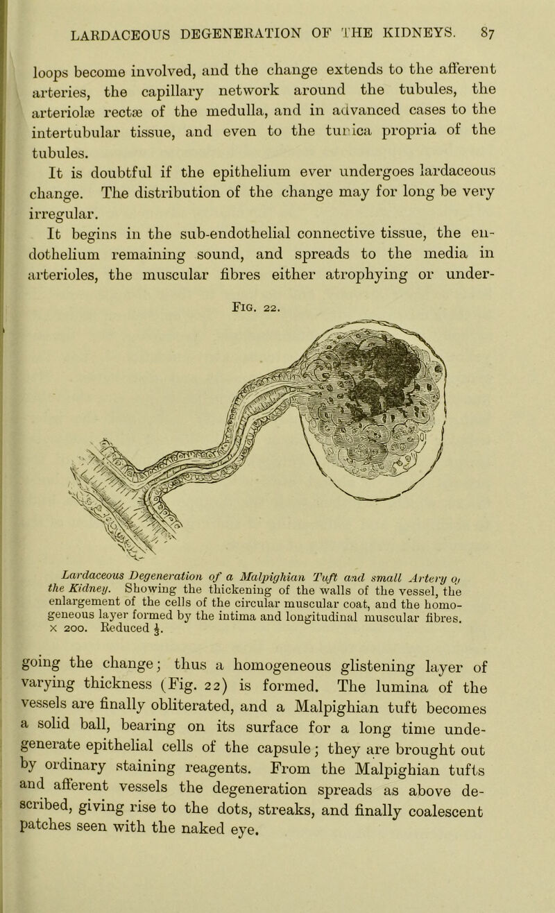 loops become involved, and the change extends to the afferent arteries, the capillary network around the tubules, the arteriolse rectie of the medulla, and in advanced cases to the intertubular tissue, and even to the tunica propria of the tubules. It is doubtful if the epithelium ever undergoes lardaceous change. The distribution of the change may for long be very irregular. It begins in the sub-endothelial connective tissue, the en- dothelium remaining sound, and spreads to the media in arterioles, the muscular fibres either atrophying or under- Fig. 22. Lardaceous Degeneration of a Malpighian Tuft and small Artery o, the Kidney. Showing the thickening of the walls of the vessel, the enlargement of the cells of the circular muscular coat, and the homo- geneous layer formed by the intima and longitudinal muscular fibres, x 200. Reduced going the change; thus a homogeneous glistening layer of varying thickness (Fig. 22) is formed. The lumina of the vessels are finally obliterated, and a Malpighian tuft becomes a solid ball, bearing on its surface for a long time unde- generate epithelial cells of the capsule; they are brought out by oidinary staining reagents. From the Malpighian tufts and afferent vessels the degeneration spreads as above de- scribed, giving rise to the dots, streaks, and finally coalescent patches seen with the naked eye.