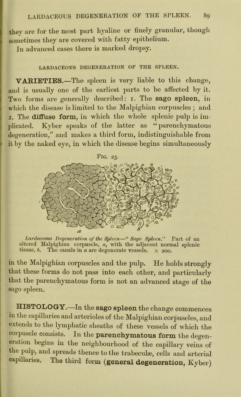 they are for the most part hyaline or finely granular, though sometimes they are covered with fatty epithelium. In advanced cases there is marked dropsy. LARDACEOUS DEGENERATION OF THE SPLEEN. VARIETIES.—The- spleen is very liable to this change, and is usually one of the earliest parts to be affected by it. Two forms are generally described: 1. The sago spleen, in which the disease is limited to the Malpighian corpuscles; and 2. The diffuse form, in which the whole splenic pulp is im- plicated. Kyber speaks of the latter as “parenchymatous degeneration,” and makes a third form, indistinguishable from * it by the naked eye, in which the disease begins simultaneously Fig. 23. Lardaceous Degeneration of the Spleen—“ Sago Spleen. Part of an altered Malpighian corpuscle, a, with the adjacent normal splenic tissue, b. The canals in a are degenerate vessels, x 200. in the Malpighian corpuscles and the pulp. He holds strongly that these forms do not pass into each other, and particularly that the parenchymatous form is not an advanced stage of the sago spleen. HISTOLOGY.—In the sago spleen the change commences in the capillaries and arterioles of the Malpighian corpuscles, and extends to the lymphatic sheaths of these vessels of which the corpuscle consists. In the parenchymatous form the clegen- eiation begins in the neighbourhood of the capillary veins of the pulp, and spreads thence to the trabeculae, cells and arterial capillaries. The third form (general degeneration, Kyber)