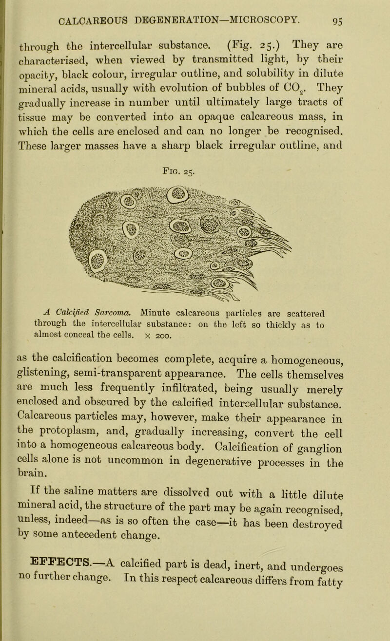 through the intercellular substance. (Fig. 25.) They are characterised, when viewed by transmitted light, by their opacity, black colour, irregular outline, and solubility in dilute mineral acids, usually with evolution of bubbles of C02. They gradually increase in number until ultimately large tracts of tissue may be converted into an opaque calcareous mass, in which the cells are enclosed and can no longer be recognised. These larger masses have a sharp black irregular outline, and Fig. 25. A Calcified Sarcoma. Minute calcareous particles are scattered through the intercellular substance: on the left so thickly as to almost conceal the cells, x 200. as the calcification becomes complete, acquire a homogeneous, glistening, semi-transparent appearance. The cells themselves are much less frequently infiltrated, being usually merely enclosed and obscured by the calcified intercellular substance. Calcareous particles may, however, make their appearance in the protoplasm, and, gradually increasing, convert the cell into a homogeneous calcareous body. Calcification of ganglion cells alone is not uncommon in degenerative processes in the brain. If the saline matters are dissolved out with a little dilute mineral acid, the structure of the part may be again recognised, unless, indeed—as is so often the case—it has been destroyed by some antecedent change. EFFECTS.—A calcified part is dead, inert, and undergoes no further change. In this respect calcareous differs from fatty