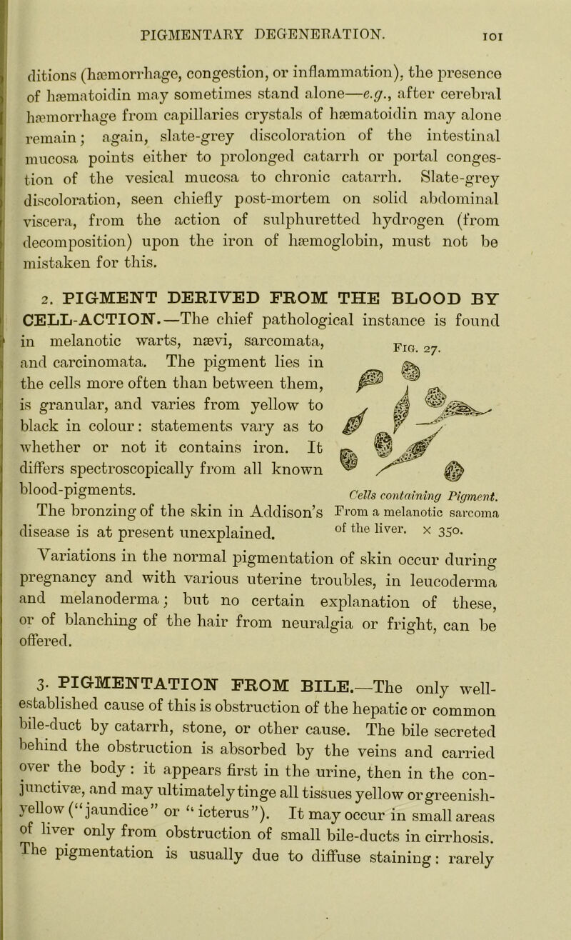 ditions (haemorrhage, congestion, or inflammation), the presence of haematoidin may sometimes stand alone—e.g., after cerebral haemorrhage from capillaries crystals of haematoidin may alone remain; again, slate-grey discoloration of the intestinal mucosa points either to prolonged catarrh or portal conges- tion of the vesical mucosa to chronic catarrh. Slate-grey discoloration, seen chiefly post-mortem on solid abdominal viscera, from the action of sulphuretted hydrogen (from decomposition) upon the iron of haemoglobin, must not be mistaken for this. 2. PIGMENT DERIVED FROM THE BLOOD BY CELL-ACTION.—The chief pathological instance is found in melanotic warts, naevi, sarcomata, and carcinomata. The pigment lies in the cells more often than between them, is granular, and varies from yellow to black in colour: statements vary as to whether or not it contains iron. It differs spectroscopically from all known blood-pigments. The bronzing of the skin in Addison’s From a melanotic sarcoma disease is at present unexplained. of tlie llver- x 35°- Variations in the normal pigmentation of skin occur during pregnancy and with various uterine troubles, in leucoderma and melanoderma; but no certain explanation of these, or of blanching of the hair from neuralgia or fright, can be offered. 3- PIGMENTATION FROM BILE.—The only well- established cause of this is obstruction of the hepatic or common bile-duct by catarrh, stone, or other cause. The bile secreted behind the obstruction is absorbed by the veins and carried over the body : it appears first in the urine, then in the con- junctiva*, and may ultimately tinge all tissues yellow or greenish- yellow ( jaundice or u icterus”). It may occur in small areas of liver only from obstruction of small bile-ducts in cirrhosis. The pigmentation is usually due to diffuse staining: rarely Fig. 27. Cells containing Pigment.