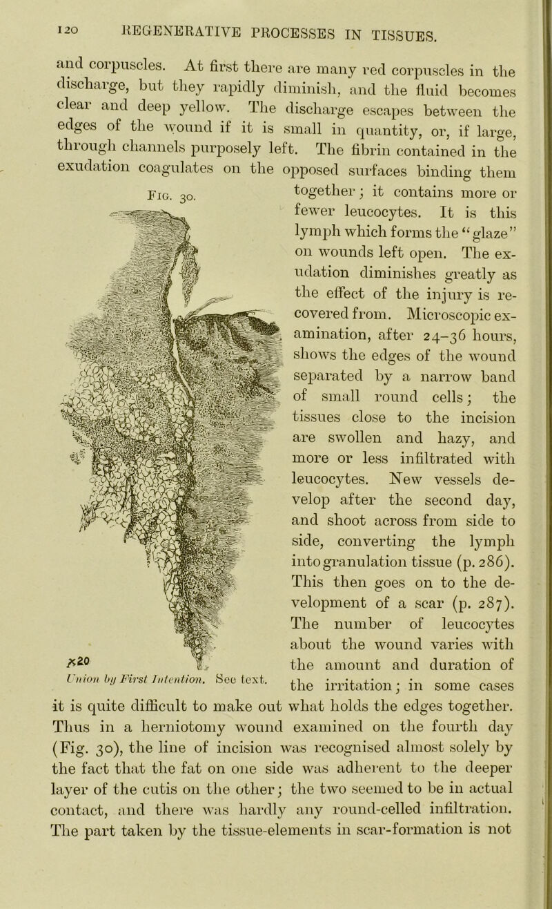 and corpuscles. At first there are many red corpuscles in the discharge, but they rapidly diminish, and the fluid becomes clear and deep yellow. The discharge escapes between the edges of the wound if it is small in quantity, or, if large, through channels purposely left. The fibrin contained in the exudation coagulates on the opposed surfaces binding them Fig. 30. together; it contains more or fewer leucocytes. It is this lymph which forms the “glaze” on wounds left open. The ex- udation diminishes greatly as the effect of the injury is re- covered from. Microscopic ex- amination, after 24-36 hours, shows the edges of the wound separated by a narrow band of small round cells; the tissues close to the incision are swollen and hazy, and more or less infiltrated with leucocytes. New vessels de- velop after the second day, and shoot across from side to side, converting the lymph into granulation tissue (p. 286). This then goes on to the de- velopment of a scar (p. 287). The number of leucocytes about the wound varies with the amount and duration of the irritation; in some cases Union by First Intention. See text. it is quite difficult to make out what holds the edges together. Thus in a herniotomy wound examined 011 the fourth day (Fig. 30), the line of incision was recognised almost solely by the fact that the fat on one side was adherent to the deeper layer of the cutis on the other; the two seemed to be in actual contact, and there was hardly any round-celled infiltration. The part taken by the tissue-elements in scar-formation is not