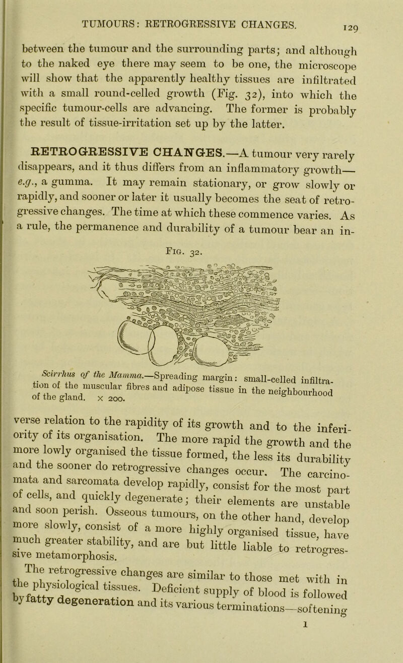 between the tumour and the surrounding parts; and although to the naked eye there may seem to be one, the microscope will show that the apparently healthy tissues are infiltrated with a small round-celled growth (Fig. 32), into which the specific tumour-cells are advancing. The former is probably the result of tissue-irritation set up by the latter. RETROGRESSIVE CHANGES.—A tumour very rarely disappears, and it thus difters from an inflammatory growth &'9mi gumma. It may remain stationary, or grow slowly or rapidly, and sooner or later it usually becomes the seat of retro- giessiv e changes. The time at which these commence varies. As a rule, the permanence and durability of a tumour bear an in- Eig. 32. Scirrhus of the Mamma.—Spreading margin: small-celled infiltra- tf°G °f fhe muscular fibres aud adipose tissue in the neighbourhood 01 toe gland, x 200. verse relation to the rapidity of its growth and to the inferi- ority of its organisation. The more rapid the growth and the more lowly organised the tissue formed, the less its durability and the sooner do retrogressive changes occur. The carcino mata and sarcomata develop rapidly, consist for the most part of cells, and quickly degenerate; their elements are unstable and soon perish. Osseous tumours, on the other hand, develop more slow y, consist of a more highly organised tissue, have much greater stability, and are but little liable to retrogres- The retrogressive changes are similar to those met with in SKT1 suPP]y of blood is followed 3 atty degenoration and its various terminations-softening I