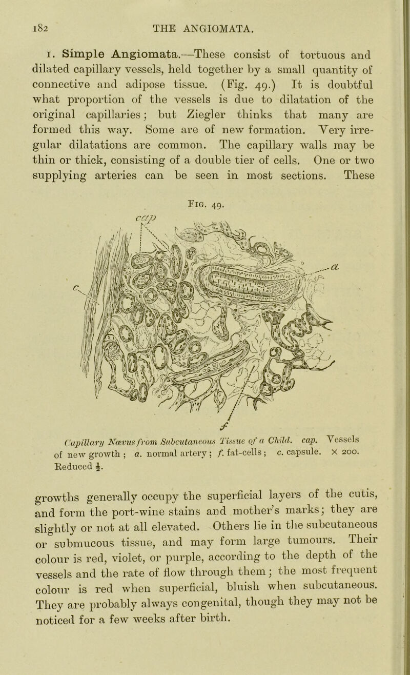i. Simple Angiomata.—These consist of tortuous and dilated capillary vessels, held together by a small quantity of connective and adipose tissue. (Fig. 49.) It is doubtful what proportion of the vessels is due to dilatation of the original capillaries; but Ziegler thinks that many are formed this way. Some are of new formation. Very irre- gular dilatations are common. The capillary walls may be thin or thick, consisting of a double tier of cells. One or two supplying arteries can be seen in most sections. These Fig. 49. if Capillary Kcevus from Subcutaneous Tissue of a Child, cap. V essels of new growth ; a. normal artery ; f. fat-cells ; c. capsule, x 200. Beduced £. growths generally occupy the superficial layers of the cutis, and form the port-wine stains and mother’s marks; they are slightly or not at all elevated. Others lie in the subcutaneous or submucous tissue, and may form large tumours. Their colour is red, violet, or purple, according to the depth of the vessels and the rate of flow through them; the most frequent colour is red when superficial, bluish when subcutaneous. They are probably always congenital, though they may not be noticed for a few weeks after birth.