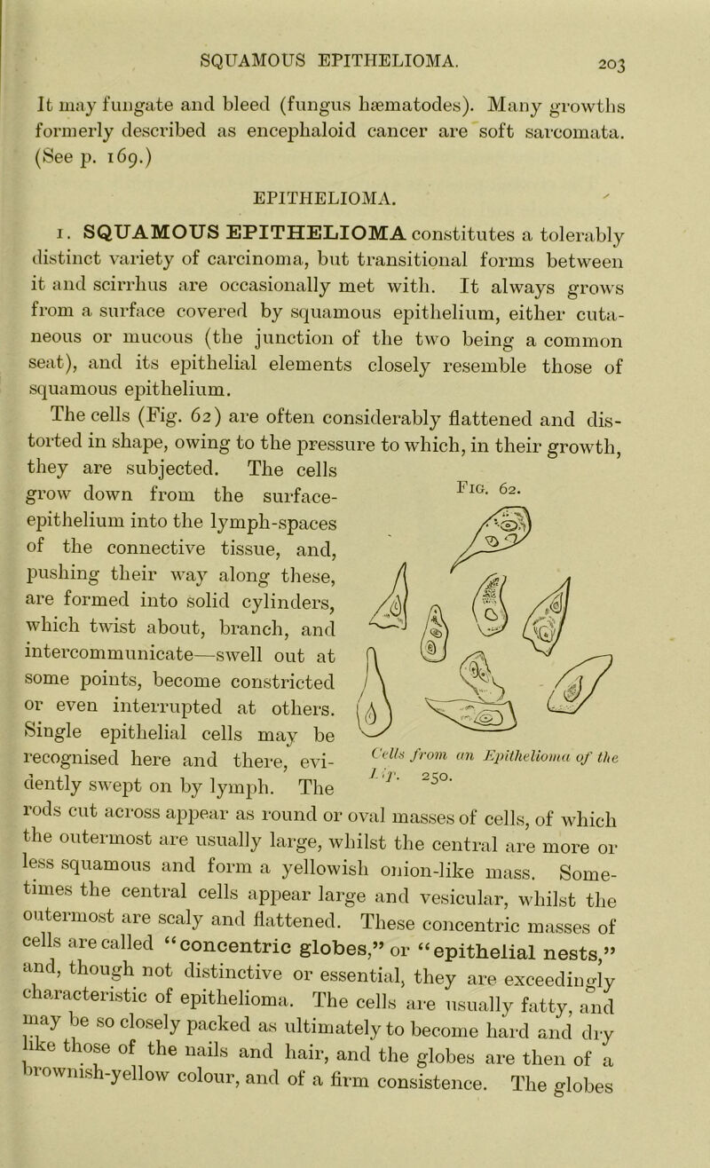 It may fungate and bleed (fungus haematodes). Many growths formerly described as enceplialoid cancer are soft sarcomata. (See p. 169.) EPITHELIOMA. 1. SQUAMOUS EPITHELIOMA constitutes a tolerably distinct variety of carcinoma, but transitional forms between it and scirrhus are occasionally met with. It always grows from a surface covered by squamous epithelium, either cuta- neous or mucous (the junction of the two being a common seat), and its epithelial elements closely resemble those of squamous epithelium. The cells (Fig. 62) are often considerably flattened and dis- torted in shape, owing to the pressure to which, in their growth, they are subjected. The cells grow down from the surface- epithelium into the lymph-spaces of the connective tissue, and, pushing their way along these, are formed into solid cylinders, which twist about, branch, and intercommunicate—swell out at some points, become constricted or even interrupted at others. Single epithelial cells may be recognised here and there, evi- dently swept on by lymph. The rods cut across appear as round or oval masses of cells, of which the outermost are usually large, whilst the central are more or less squamous and form a yellowish onion-like mass. Some- times the central cells appear large and vesicular, whilst the outermost are scaly and flattened. These concentric masses of cells are called “concentric globes,” or “epithelial nests,” and, though not distinctive or essential, they are exceedingly characteristic of epithelioma. The cells are usually fatty, and may be so closely packed as ultimately to become hard and dry 1 e those of the nails and hair, and the globes are then of a brownish-yellow colour, and of a firm consistence. The globes Fig. 62. 1 250.