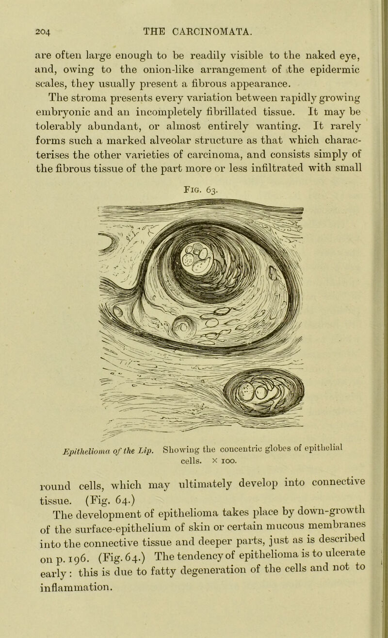 are often large enough to be readily visible to the naked eye, and, owing to the onion-like arrangement of the epidermic scales, they usually present a fibrous appearance. The stroma presents every variation between rapidly growing embryonic and an incompletely fibrillated tissue. It may be tolerably abundant, or almost entirely wanting. It rarely forms such a marked alveolar structure as that which charac- terises the other varieties of carcinoma, and consists simply of the fibrous tissue of the part more or less infiltrated with small Fig. 63. Epithelioma of the Lip. Showing the concentric globes of epithelial cells, x 100. round cells, which may ultimately develop into connective tissue. (Fig* 64.) The development of epithelioma takes place by down-growth of the surface-epithelium of skin or certain mucous membranes into the connective tissue and deeper parts, just as is described on p.196. (Fig. 64.) The tendency of epithelioma is to ulcerate early: this is due to fatty degeneration of the cells and not to inflammation.