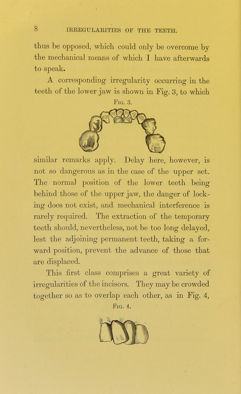 thus be opposed, which could only be overcome by the mechanical means of which I have afterwards to speak. A corresponding irregularity occurring in the teeth of the lower jaw is shown in Fig. 3, to which Fig. 3. similar remarks apply. Delay here, however, is not so dangerous as in the case of the upper set. The normal position of the lower teeth being behind those of the upper jaw, the danger of lock- ing does not exist, and mechanical interference is rarely required. The extraction of the temporary teeth should, nevertheless, not be too long delayed, lest the adjoining permanent teeth, taking a for- ward position, prevent the advance of those that are displaced. This first class comprises a great variety of irregularities of the incisors. They may be crowded together so as to overlap each other, as in Fig. 4, Pig. 4.