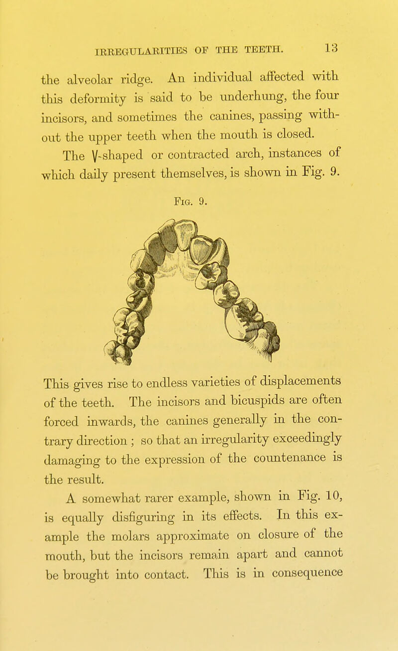 the alveolar ridge. An individual affected with this deformity is said to be underhung, the four incisors, and sometimes the canines, passing with- out the upper teeth when the mouth is closed. The V-shaped or contracted arch, instances of which daily present themselves, is shown in Fig. 9. Fig. 9. This gives rise to endless varieties of displacements of the teeth. The incisors and bicuspids are often forced inwards, the canines generally hi the con- trary direction ; so that an irregularity exceedingly damaging to the expression of the countenance is the result. A somewhat rarer example, shown in Fig. 10, is equally disfiguring in its effects. In this ex- ample the molars approximate on closure of the mouth, but the incisors remain apart and cannot be brought into contact. This is in consequence