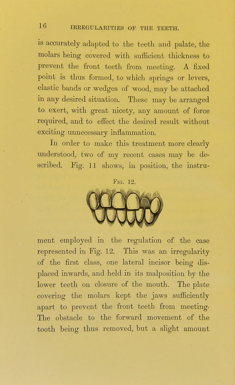 is accurately adapted to the teeth and palate, the molars being covered with sufficient thickness to prevent the front teeth from meeting. A fixed point is thus formed, to which springs or levers, elastic bands or wedges of wood, may be attached in any desired situation. These may be arranged to exert, with great nicety, any amount of force required, and to effect the desired result without exciting unnecessary inflammation. In order to make this treatment more clearly understood, two of my recent cases may be de- scribed. Fig. 11 shows, in position, the instru- Fig. 12. ment employed in the regulation of the case represented in Fig. 12. This was an irregularity of the first class, one lateral incisor being dis- placed inwards, and held in its malposition by the lower teeth on closure of the mouth. The plate covering the molars kept the jaws sufficiently apart to prevent the front teeth from meeting. The obstacle to the forward movement of the tooth being thus removed, but a slight amount