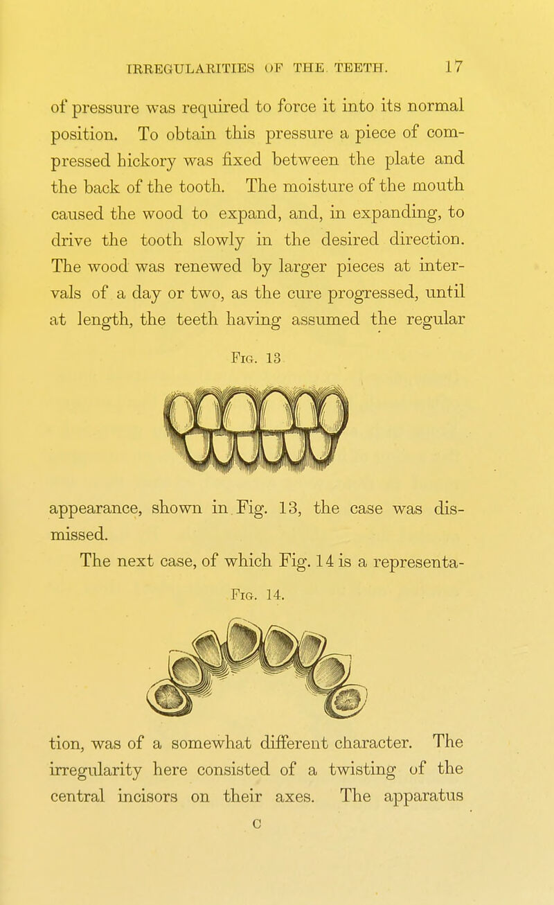 of pressure was required to force it into its normal position. To obtain this pressure a piece of com- pressed hickory was fixed between the plate and the back of the tooth. The moisture of the mouth caused the wood to expand, and, in expanding, to drive the tooth slowly in the desired direction. The wood was renewed by larger pieces at inter- vals of a day or two, as the cure progressed, until at length, the teeth having assumed the regular Fig. 13 appearance, shown in. Fig. 13, the case was dis- missed. The next case, of which Fig. 14 is a representa- Fig. 14. tion, was of a somewhat different character. The irregularity here consisted of a twisting of the central incisors on their axes. The apparatus c