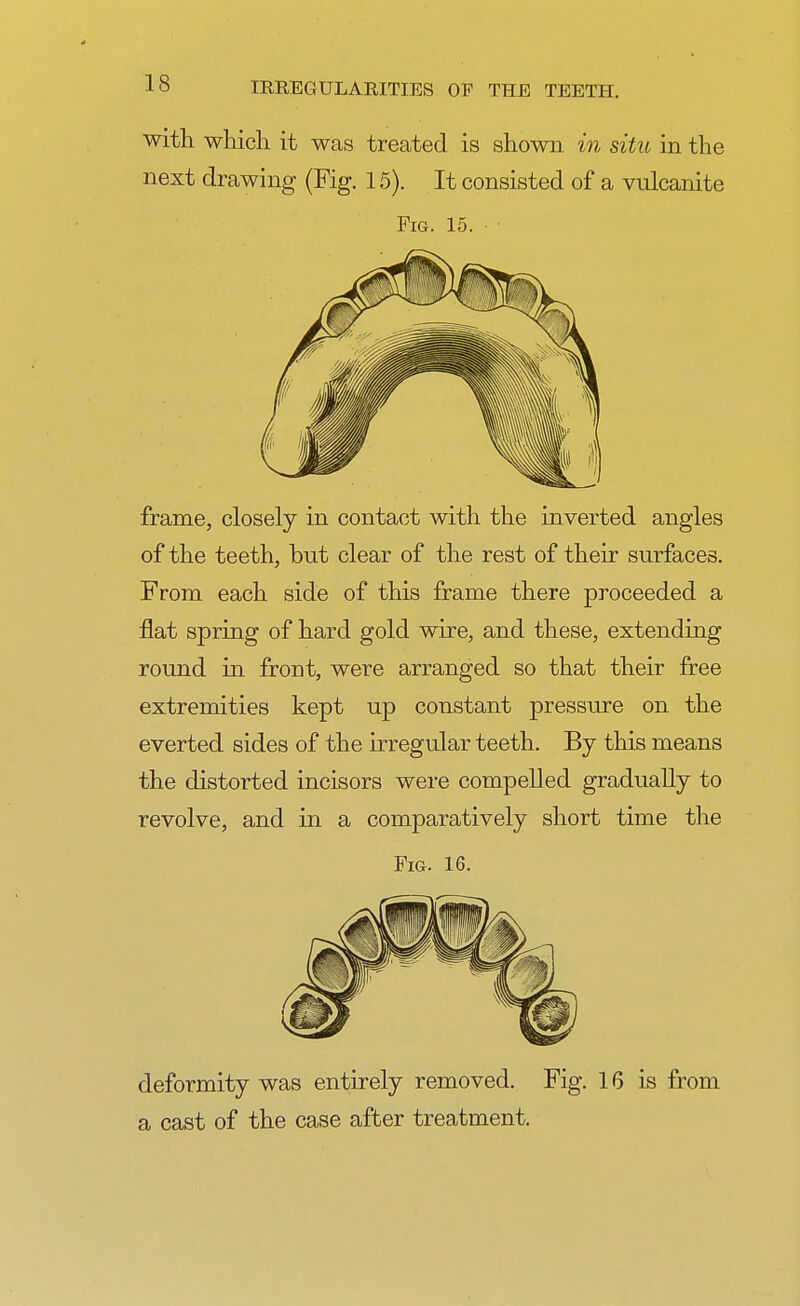 with which it was treated is shown in situ in the next drawing (Fig. 15). It consisted of a vulcanite Fiq. 15. frame, closely in contact with the inverted angles of the teeth, but clear of the rest of their surfaces. From each side of this frame there proceeded a flat spring of hard gold wire, and these, extending round in front, were arranged so that their free extremities kept up constant pressure on the everted sides of the irregular teeth. By this means the distorted incisors were compelled gradually to revolve, and in a comparatively short time the Fig. 16. deformity was entirely removed. Fig. 16 is from a cast of the case after treatment.