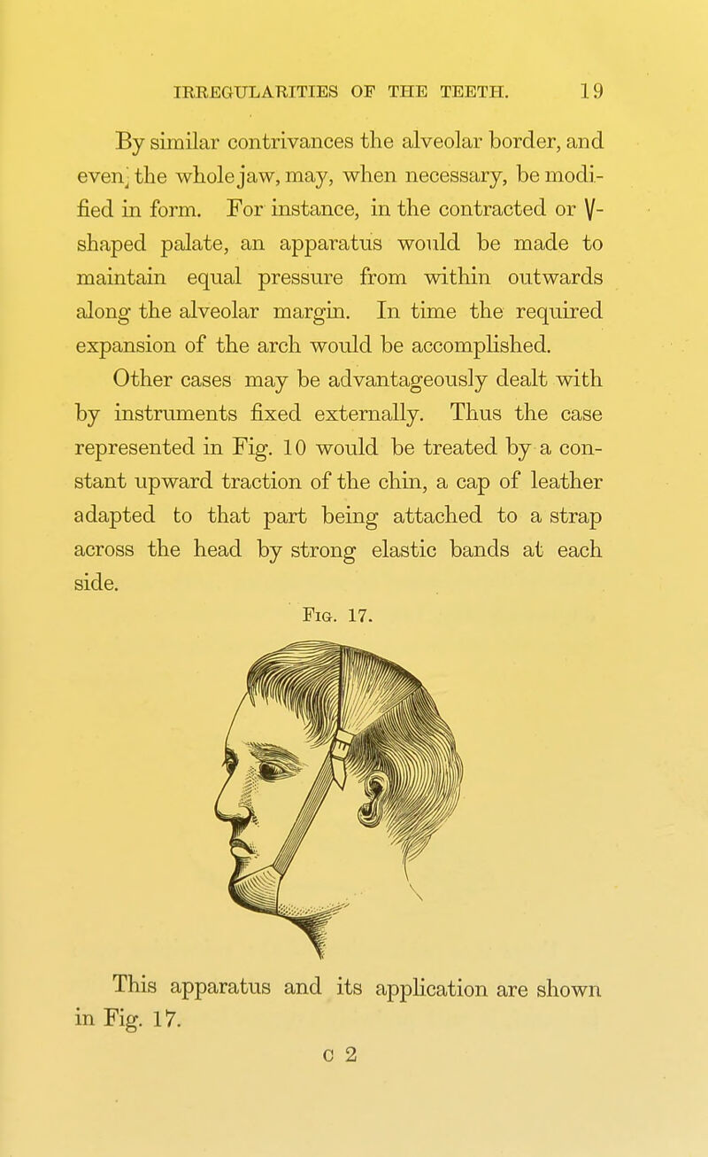 By similar contrivances the alveolar border, and evenj the whole jaw, may, when necessary, be modi- fied in form. For instance, in the contracted or V~ shaped palate, an apparatus would be made to maintain equal pressure from within outwards along the alveolar margin. In time the required expansion of the arch would be accomplished. Other cases may be advantageously dealt with by instruments fixed externally. Thus the case represented in Fig. 10 would be treated by a con- stant upward traction of the chin, a cap of leather adapted to that part being attached to a strap across the head by strong elastic bands at each side. Fig. 17. This apparatus and its application are shown in Fig. 17. c 2