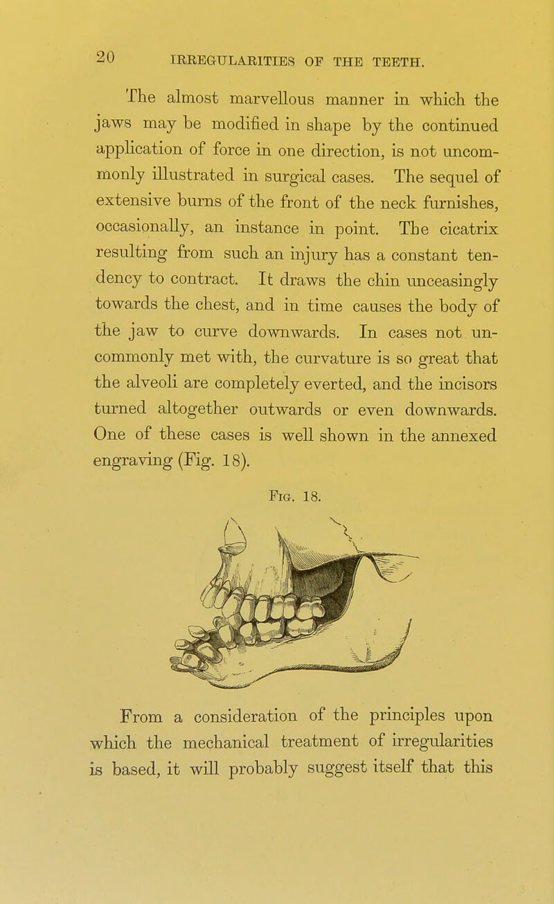 The almost marvellous manner in which, the jaws may be modified in shape by the continued application of force in one direction, is not uncom- monly illustrated in surgical cases. The sequel of extensive burns of the front of the neck furnishes, occasionally, an instance in point. The cicatrix resulting from such an injury has a constant ten- dency to contract. It draws the chin unceasingly towards the chest, and in time causes the body of the jaw to curve downwards. In cases not un- commonly met with, the curvature is so great that the alveoli are completely everted, and the incisors turned altogether outwards or even downwards. One of these cases is well shown in the annexed engraving (Fig. 18). Fig. 18. From a consideration of the principles upon which the mechanical treatment of irregularities is based, it will probably suggest itself that this