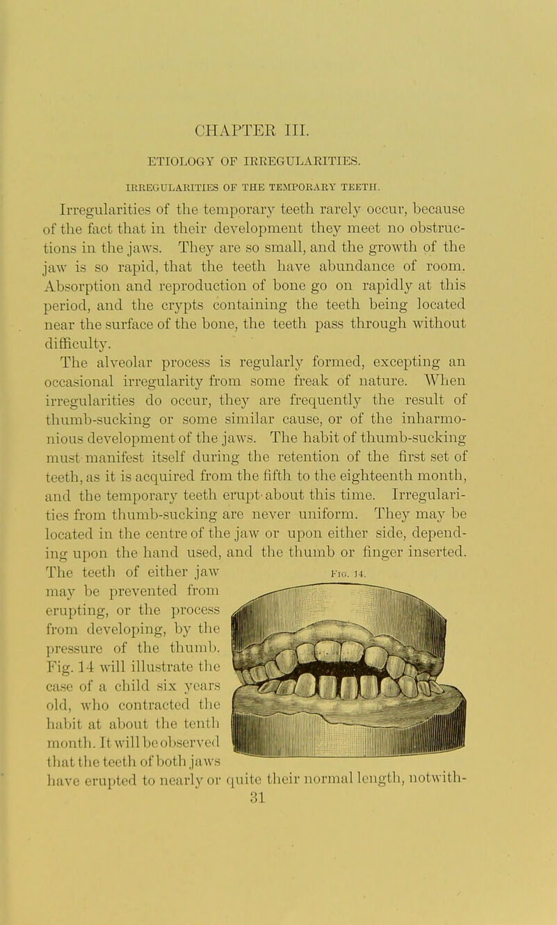 ETIOLOGY OF lEEEGULARITIES. IRREGULARITIES OF THE TEMPORARY TEETH. Irregularities of the temporary teeth rarely occur, because of the fact that in their development they meet no obstruc- tions in the jaws. They are so small, and the growth of the jaw is so rapid, that the teeth have abundance of room. Absorption and reproduction of bone go on rapidly at this period, and the crypts containing the teeth being located near the surface of the bone, the teeth pass through without difficulty. The alveolar process is regularly formed, excepting an occasional irregularity from some freak of nature. When irregularities do occur, they are frequently the result of thumb-sucking or some similar cause, or of the inharmo- nious development of the jaws. The habit of thumb-sucking must manifest itself during the retention of the first set of teeth, as it is acquired from the fifth to the eighteenth month, and the temporary teeth erupt' about this time. Irregulari- ties from thumb-sucking are never uniform. They may be located in the centre of the jaw or upon either side, depend- ing upon the hand used, and the thumb or finger inserted. The teeth of either jaw i-io. 14. may be prevented from erupting, or the process from developing, by the pressure of the thumb. Fig. 14 will illustrate the case of a child six years old, who contracted the habit at about the tenth month. It will be oljservc( I tliat the teeth of both jaws have erupted to nearly or quite their normal length, notwith-