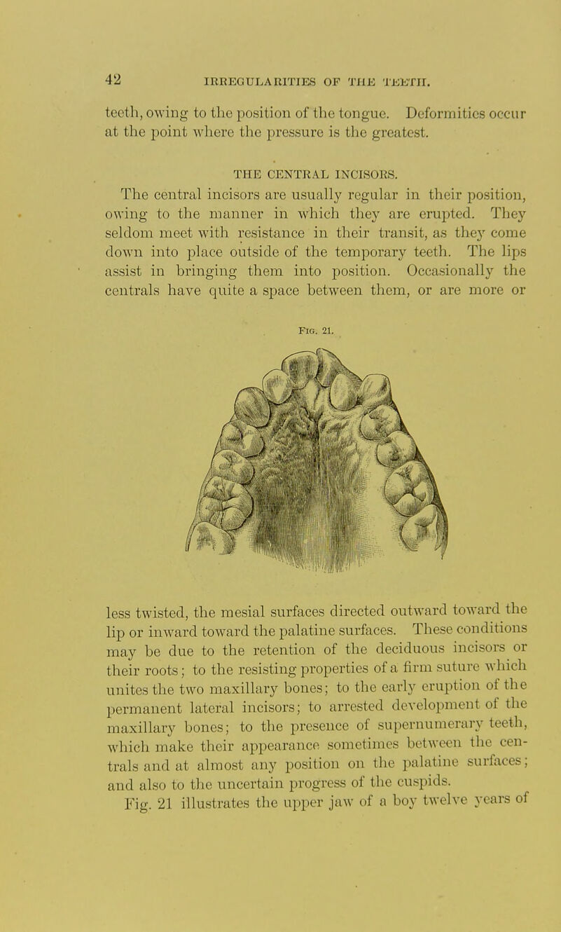 teeth, owing to the position of the tongue. Deformities occur at the point \vhere the pressure is the greatest. THE CENTRAL INCISORS. The central incisors are usually regular in their position, owing to the manner in which they are erupted. They seldom meet with resistance in their transit, as the}' come down into place outside of the temporary teeth. The lips assist in bringing them into position. Occa.sionally the centrals have quite a space between them, or are more or Fig. 21. less twisted, the mesial surfaces directed outward toward the lip or inward toward the palatine surfaces. These conditions may be due to the retention of the deciduous incisors or their roots; to the resisting properties of a firm suture which unites the two maxillary bones; to the early eruption of the permanent lateral incisors; to arrested development of the maxillary bones; to the presence of supernumerary teeth, which make their appearance sometimes between the cen- trals and at almost any position on the palatine surfaces; and also to the uncertain progress of the cuspids. Fig. 21 illustrates the upper jaw of a boy twelve years of