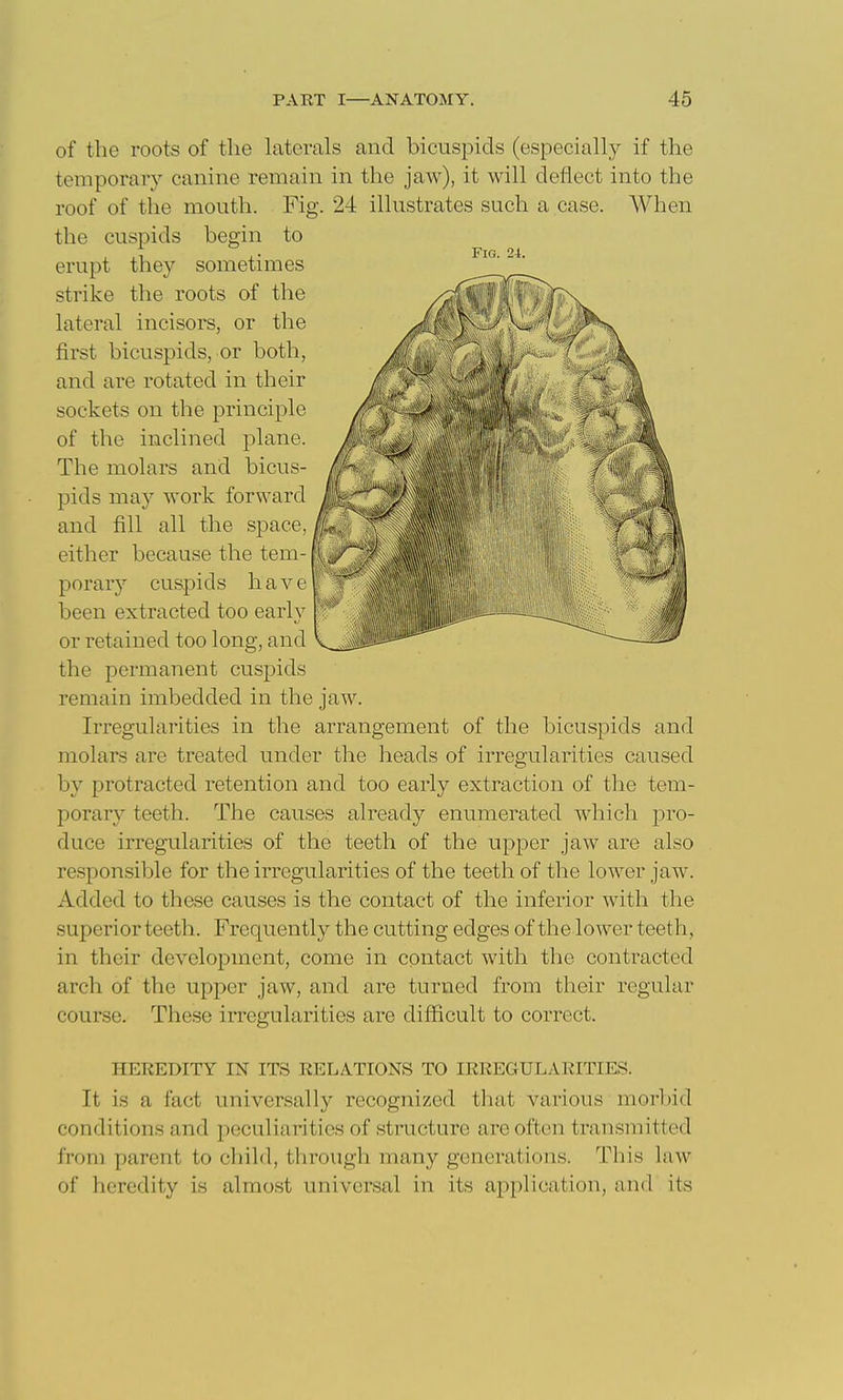 of the roots of tlie laterals and bicuspids (especially if the temporary canine remain in the jaw), it will deflect into the roof of the mouth. Fig. 24 illustrates such a case. When the cuspids begin to erupt they sometimes strike the roots of the lateral incisors, or the first bicuspids, or both, and are rotated in their sockets on the principle of the inclined plane. The molars and bicus- pids may work forward and fill all the space, either because the tem- porary cuspids have been extracted too earlv or retained too long, and the permanent cuspids remain imbedded in the jaw. Irregularities in the arrangement of the bicuspids and molars are treated under the heads of irregularities caused by protracted retention and too early extraction of the tem- porary teeth. The causes already enumerated which pro- duce irregularities of the teeth of the upper jaw are also responsible for the irregularities of the teeth of the lower jaw. Added to these causes is the contact of the inferior with the superior teeth. Frequently the cutting edges of the lower teeth, in their development, come in cpntact with the contracted arch of the upper jaw, and are turned from their regular course. These irregularities are difficult to correct. HEREDITY IN ITS RELATIONS TO IRREGULARITIES. It is a fact universally recognized that various morbid conditions and peculiarities of structure are often transmitted from parent to child, through many generations. This law of heredity is almost universal in its application, and its