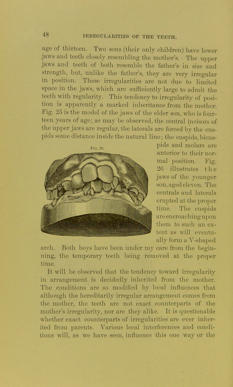 age of thirteen. Two sons (their only children) have lower jaws and teeth closely resembling the mother's. The upper jaws and teeth of both resemble tlie father's in size and strength, but, unlike the father's, they are very irregular in position. These irregularities are not due to limited space in the jaws, which are sufficiently large to admit the teeth with regularity. This tendency to irregularity of posi- tion is apparently a marked inheritance from the mother. Fig. 25 is the model of the jaws of the elder son, who is four- teen years of age; as may be observed, the central incisors of the upper jaws are regular, the laterals are forced by the cus- pids some distance inside the natural line; the cuspids, bicus- jDids and molars are anterior to their nor- mal position. Fig. jaws of the younger son, aged eleven. The centrals and laterals erupted at the proper time. The cuspids are encroaching upon tliem to such an ex- tent as will eventu- alh' form a V-shaped arch. Both boys have been under my care from the begin- ning, the temporary teeth being removed at the proper time. It will be observed that the tendencv toward irregularitv in arrangement is decidedly inherited from the mother. The conditions are so modified by local influences that although the hereditarily irregular arrangement comes from the mother, the teeth are not exact counterparts of the mother's irregularity, nor are they alike. It is questionable whether exact counterparts of irregularities are ever inher- ited from parents. Various local interferences and condi- tions will, as we have seen, influence this one way or the