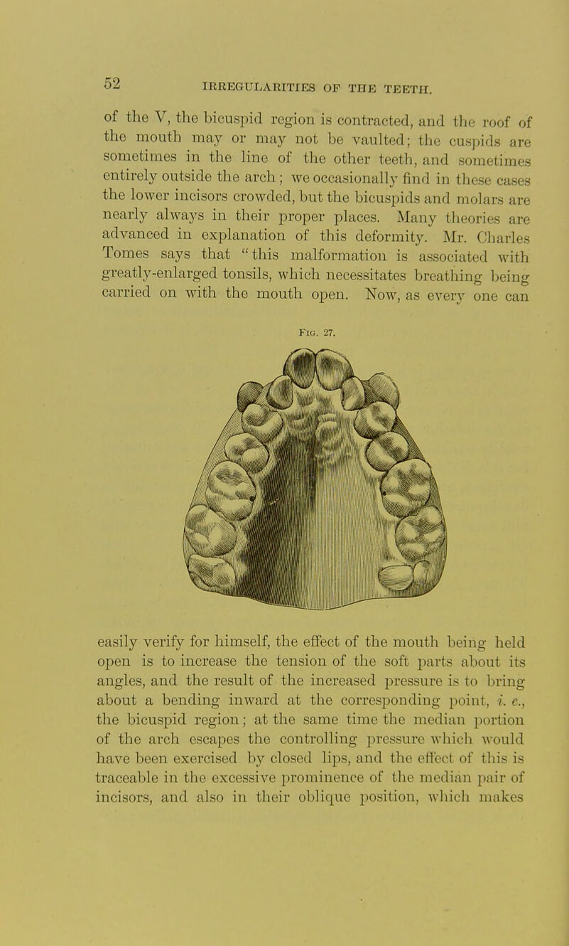 of the V, the bicuspid region is contracted, and the roof of the mouth may or may not be vaulted; the cuspids are sometimes in the hne of the other teeth, and sometimes entirely outside the arch ; we occasionally find in these cases the lower incisors crowded, but the bicuspids and molars are nearly always in their proper places. Many theories are advanced in explanation of this deformity. Mr. Charles Tomes says that this malformation is associated with greatly-enlarged tonsils, which necessitates breathing being carried on with the mouth open. Now, as every one can Fig. 27. easily verify for himself, the effect of the mouth being held open is to increase the tension of the soft parts about its angles, and the result of the increased pressure is to bring about a bending inward at the corresi^onding point, i. c, the bicuspid region; at the same time the median portion of the arch escapes the controlling pressure which would have been exercised by closed lips, and the effect of this is traceable in the excessive prominence of the median pair of incisors, and also in their oblique position, Avliich makes