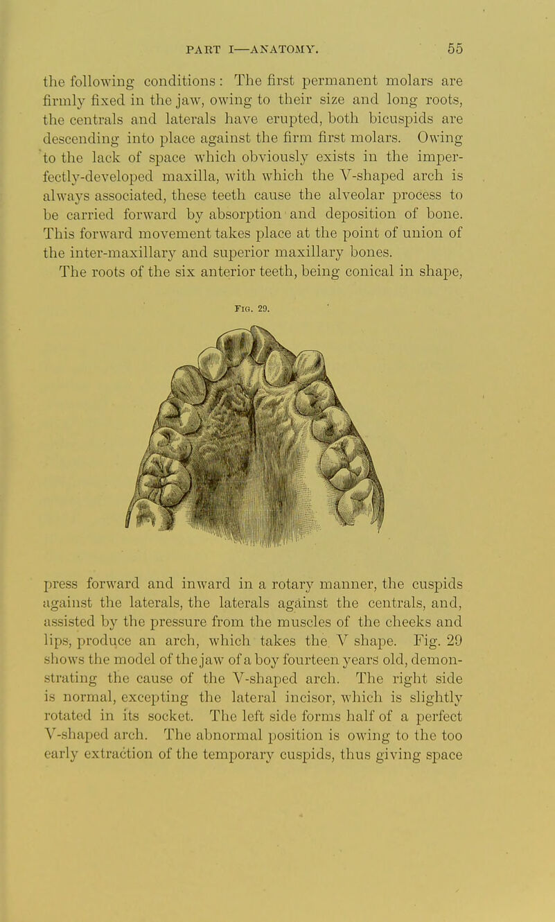 the following conditions : The first permanent molars are firmly fixed in the jaw, owing to their size and long roots, the centrals and laterals have erupted, both bicuspids are descending into place against the firm first molars. Owing to the lack of space which obviously exists in the imper- fectly-developed maxilla, with which the V-shaped arch is always associated, these teeth cause the alveolar process to be carried forward by absorption' and deposition of bone. This forward movement takes place at the point of union of the inter-maxillary and superior maxillary bones. The roots of the six anterior teeth, being conical in shape, Fig. 29. press forward and inward in a rotary manner, the cuspids against the laterals, the laterals against the centrals, and, assisted by the pressure from the muscles of the cheeks and lips, produce an arch, which takes the. V shape. Fig. 29 shows the model of the jaw of a boy fourteen years old, demon- strating the cause of the V-shaped arch. The right side is normal, excepting the lateral incisor, which is slightly rotated in its socket. The left side forms half of a perfect V-shaped arch. The abnormal position is owing to the too early extraction of the temporary cuspids, thus giving space