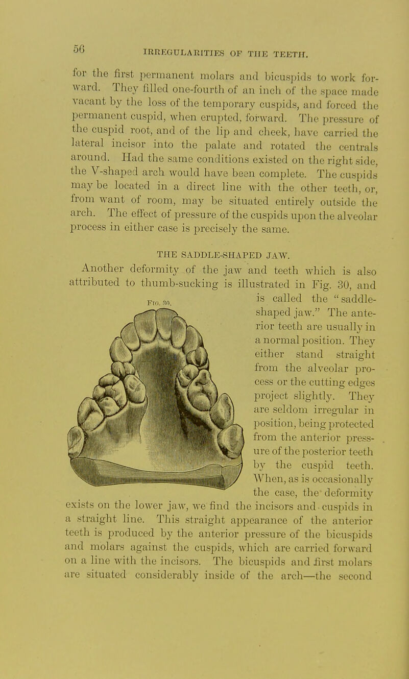 for the first permanent molars and bicuspids to work for- ward. They filled one-fourth of an inch of the space made vacant by the loss of the temporary cuspids, and forced the permanent cuspid, when erupted, foi-ward. The pressure of the cuspid root, and of the lip and cheek, have carried tlie lateral incisor into the palate and rotated the centrals around. Had the same conditions existed on the right side, the V-shaped arch would have been complete. The cuspids may be located in a direct line with the other teeth, or, from want of room, may be situated entirely outside the arch. The effect of pressure of the cuspids upon the alveolar process in either case is precisely the same. THE SADDLE-SHAPED JAW. Another deformity of the jaw and teeth which is also attributed to thumb-sucking is illustrated in Fig. 30, and is called the saddle- shaped jaw. The ante- rior teeth are usuall}' in a normal j^osition. They either stand straight from the alveolar pro- cess or the cutting edges project slightly. They are seldom irregular in position, being protected from the anterior press- ure of the posterior teeth by the cuspid teeth. When, as is occasionally the case, the' deformity exists on the lower jaw, we find the incisors and cuspids in a straight line. This straight appearance of the anterior teeth is produced by the anterior pressure of the bicuspids and molars against the cuspids, which are carried forward on a line with the incisors. The bicuspids and first molars are situated considerably inside of the arch—the second Fm. sn.