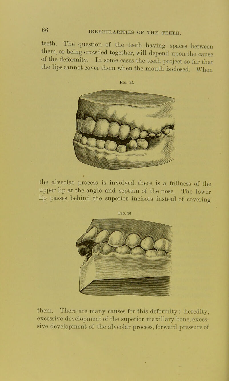 teeth. The question of the teeth having spaces between them, or being crowded together, will depend upon the cause of the deformit3^ In some cases the teeth project so far that the lips cannot cover them when the mouth is closed. When Fig. 35. the alveolar process is involved, there is a fullness of the upper lip at the angle and septum of the nose. The lower lip passes behind the superior incisors instead of covering Fig. 36 them. There are many causes for this deformity: heredity, excessive development of the superior maxillary bone, exces- sive development of the alveolar process, forward pressure of