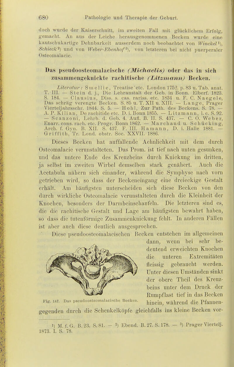 doch wurde der Kaiserschnitt, im /.weiten Fall mit glücklichem Erfolg, gemacht. An aus der 1,eiche herausgenommenen Becken wurde eine kautschukartige Dehnbarkeit ausserdem noch beobachtet von Winckel1), Schieck'1) und von Weber-Ebenhof6), von letzteren hei nicht puerperaler < isteomälacie. Das pseudoosteomalacische (Michaelis) oder das in sich zusammengeknickte rachitische (I/itzniann) Becken. Literatur : S in e 11 i e , Treatise 'etc. London 1752. p. 83 u. Tab. anat. T. III. — Stein d. j., Die Lehranstalt der Geb. in Bonn. Elberf. 1823. S. 184. — Clausius, Diss. s. cas. rariss. etc. 1834 u. F. C. Naegele, Das schräg verengte Becken. S. 85 u. T. XII u. XIII. — Lange, Prager Vierteljahrssc.hr. 1844. S. 5. — Hohl, Zur Path. des Beckens. S. 78. — A.P.Kilian, De rachitide etc. D. i. Bonn 1855. — Litzmann, I.e. S. 92. — Scanzoni, Lehrb. d. Geb. 4. Aufl. B. II. S. 437. — C. 0. Weber, Enarr. cons. räch. etc. Progr. Bonn 1862. — Marchand u. Schücking, Arch. f. Gvn. B. XII. S. 437. F. III. Hamann, D. i. Halle 1881. — Griffith/Tr. Lond. obsrr. Soc. XXVII. 1886. Dieses Becken hat auffallende Aehnlichkeit mit dem durch Osteomalacie verunstalteten. Das Prom. ist tief nach unten gesunken, und das untere Ende des Kreuzbeins durch Knickung im dritten, ja selbst im zweiten Wirbel demselben stark genähert. Auch die Acetabnla nähern sich einander, während die Symphyse nach vorn getrieben wird, so dass der Beckeneingang eine dreieckige Gestalt erhält. Am häufigsten unterscheiden sich diese Becken von den durch wirkliche Osteomalacie verunstalteten durch die Kleinheit der Knochen, besonders der Darmbeinschanfeln. Die letzteren sind es, die die rachitische Gestalt und Lage am häufigsten bewahrt haben, so dass die tutenförmige Zusammenknickung fehlt. In anderen Fällen ist aber auch diese deutlich ausgesprochen. Diese pseudoosteomalacischen Becken entstehen im allgemeinen dann, wenn bei sehr be- deutend erweichten Knochen die unteren Extremitäten fleissig gebraucht werden. Unter diesen Umständen sinkt der obere Theil des Kreuz- beins unter dem Druck der Rumpf last tief in das Becken Fig. 147. Das pseudoosteomalacische Becke,.. jjj^^ wiibreud die PfanueiV- gegenden durch die Schenkel köpfe gleichfalls ins kleine Becken vor- i) M. f. G. B.23. S.81. - 2) Ebend. B. 27. S. 178. — 3) Prager Viertel]. 1873. I. S. 78.