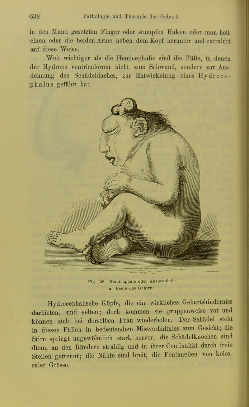 in den Mund gesetzteu Finger oder stumpfeu Haken oder man liolt einen oder die beidenArme neben dem Kopf heruuter und extrahirt auf diese Weise. Weit wichtiger als die Hemiceplialie sind die Falle, in deneu der Hydrops veutriculorum nicht zum Schwund, sondern zur Aus- dehnung des Schadeldaches, zur Entwickelung eiues Hydroee- .plialus gefUhrt hat. Fig. 138. Hemicephale oder Anencephale. a. Beste des Gehirns. Hydrocepbalische Kdpfe, die ein wirklicbes Geburtshindemiss darbieten, sind selten; doch kommeu sie gruppenweise vor und kSnnen sich bei derselben Frau wiederholen. Der Schadel steht in diesen Fallen in bedeutendem Missverhaltniss zum Gesicht; die Stim springt ungewohnlich stark hervor, die Schadelknoclien sind dtlnn, an den Randern straUig und in ihrer Continuitat durch freie Stellen getrennt; die Nabte sind breit, die Fontanellen von kolos- saler Grosse.