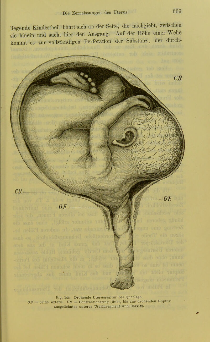 liegende Kindestheil bohrt sich an der Seite, die nachgiebt, zwischen sie hinein und sucht hier den Ausgang. Auf der Hohe einer Wehe kommt es zur voUstiindigen Perforation der Substanz, der durch- Fig. 144. Drohende Uterusruptur bel Qnerlage. OE = orlflo. extern. CR = Oontractionsring (links, bis zur drobenden Ruptur ausgedehntes unteres Uterlnsegment und Cervix).