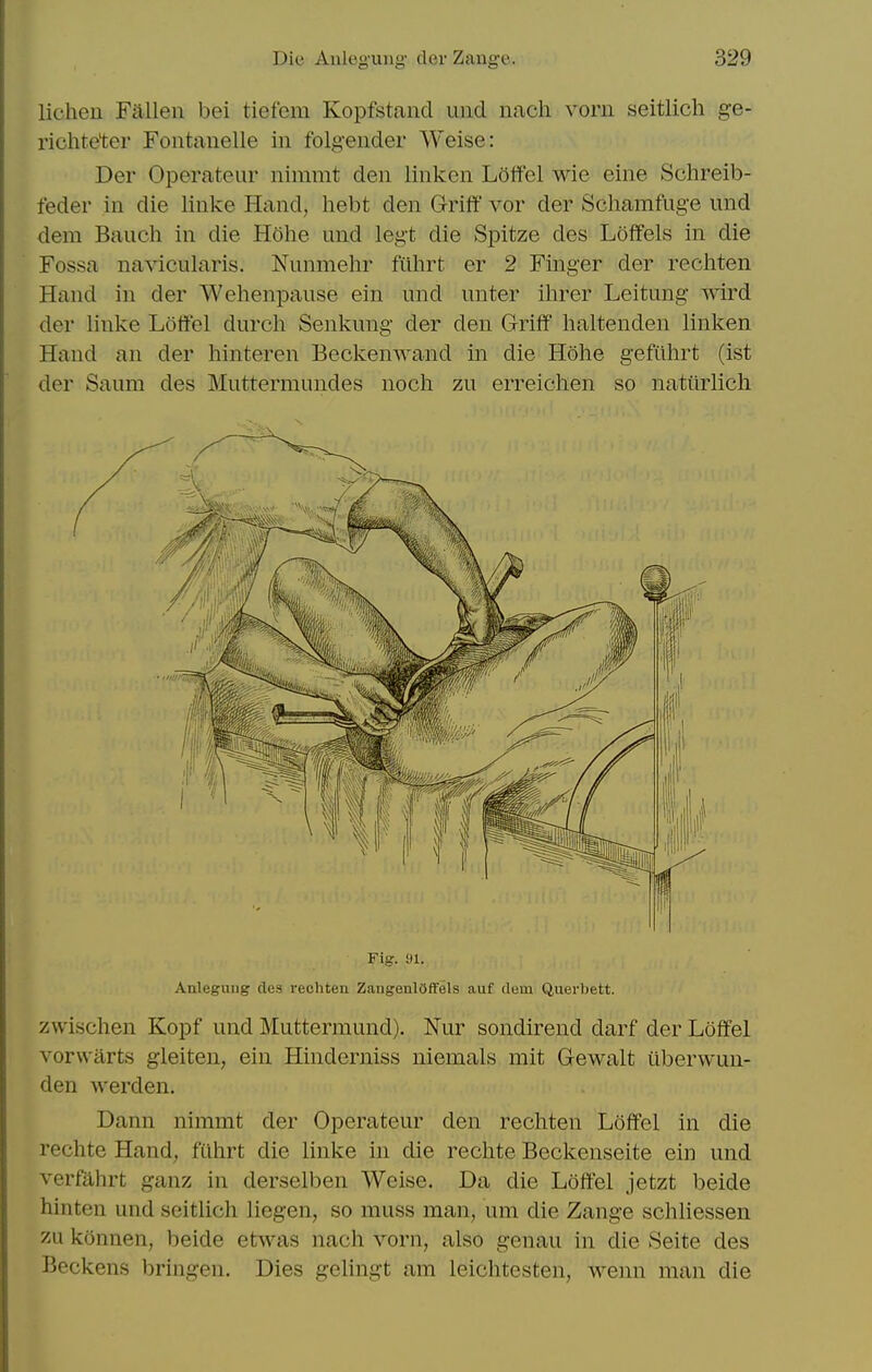 lichen Fallen bei tiefom Kopfstand und nach vorn seitlich ge- richteter Fontanelle in folgender Weise: Der Operateur nimmt den linken Loffel wie sine Sclireib- feder in die linke Hand, hebt den G-riff vor der Schamfuge und dem Bauch in die Hohe und legt die Spitze des Loffels in die Fossa navicularis. Nunmehr fiihrt er 2 Finger der rechten Hand in der Wehenpause ein und unter ihrer Leitung wird der linke Lotfel durch Senkung der den GrifF haltenden linken Hand an der hinteren Beckenwand in die Hohe gefiihrt (ist der Saum des Muttermundes nocli zu erreichen so natiirlich Fig-. 91. Anlegniig des rechten ZaugenlOffels auf duin Querbett. zwischen Kopf und Muttermund). Nur sondirend darf der Loffel vorwarts gleiten, ein Hinderniss niemals mit Gewalt iiberwun- den werden. Dann nimmt der Operateur den rechten Loffel in die rechte Hand, fiihrt die linke in die rechte Beckenseite ein und verfahrt ganz in derselben Weise. Da die Loffel jetzt beide hinten und seitlich liegen, so muss man, um die Zange schliessen zu konnen, beide etwas nach vorn, also genau in die Seite des Beckens bringen. Dies gelingt am leichtesten, wenn man die