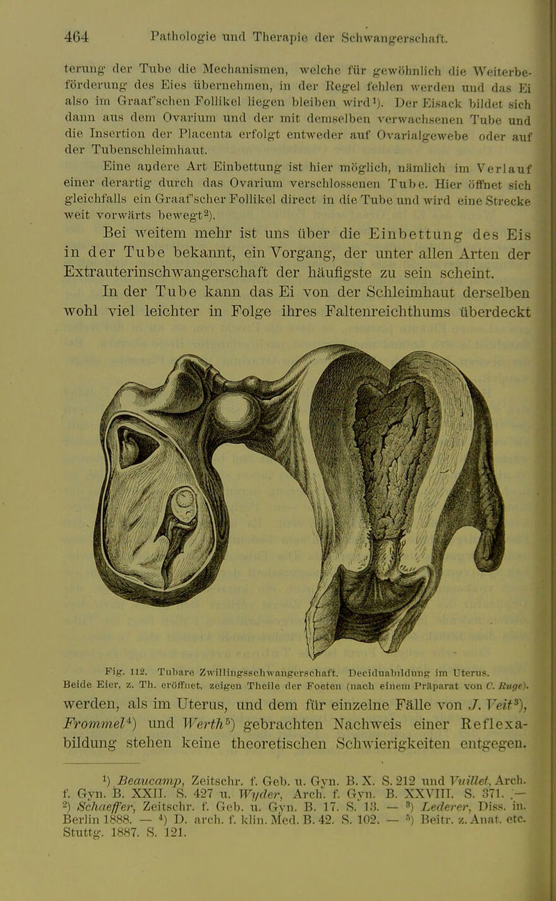 tenuig- der Tube die Mechanismen, welche fiir gewohnlich die Weiterbe- forderuiig des Eies iibernelunen, in der Kegel felilen werden uud das Ei also im Graafsclien Follikel liegen bleiben wird^). Der Eisack bildet sich daiin axis dem Ovarium und der mit demselben verwachsenen Tube und die Insertion der Placenta erfolgt entweder auf Ovarialgewebe oder auf der Tubenschleimhaut. Eine aijdere Art Einbettung ist hier moglich, nMrnlich im Verlauf einer derartig- durch das Ovarium verschlossenen Tube. Hier offnet sich gleichfalls ein Graaf scher Follikel direct in die Tube und Avird eine Strecke weit vorwarts bewegt^). Bei weitem mehr ist uns tiber die Einbettung des Eis in der Tube bekannt, ein Vorgang, der unter alien Arten der Extrauterinschwangerscliaft der haufigste zu sein scheint. In der Tube kann das Ei von der Schleimhaut derselben wohl viel leichter in Folge ihres Faltenreichtliums iiberdeckt Fig. 112. Tubare Zwillingsschwangerschaft. Decidualjildnng im Uterus. Beide Eier, z. Th. erOffiiet, zeigen Theile der Foeteu (nach einem PrSparat von C. Ru^e). werden, als im Uterus, und dem fur einzelne Falle von J. Veif^), FrommeV) und Werth^) gebrachten Nachweis einer Reflexa- bildung stehen keine theoretischen Sclnvierigkeiten entgegen. 1) Beaucamp, Zeitschr. f. Geb. u. Gvn. B. X. S. 212 wwA Vvillet, kvc\\. f. Gyn. B. XXII. S. 427 u. Wyder, Arch. f. Gvn. B. XXVTIT. S. 371. .— 2) Schaeffer, Zeitschr. f. Geb. u. Gvn. B. 17. S. 13. — 3) Lederer, Diss. in. Berlin 1888. — ■») D. arch. f. klin. Med. B. 42. R. 102. — S) Beitr. z.Anat. etc. Stuttg-. 1887. S. 121.