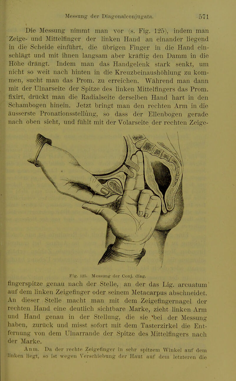 Die Messimg- nimmt man vor (s. Fig-. 125), indem man. Zeige- and Mittelfinger der linken Hand an einander liegend in die Scheide einfiihrt, die iibrigen Finger in die Hand ein- sehlagt und mit ilmen langsam aber kraftig den Damm in die Hohe drangt. Indem man das Handgelenk stark senkt, um nieht so weit nacli hinten in die Kreuzbeinaushohlung zu kom- men, suclit man das Prom, zu erreichen, Wahrend man dann mit der Ulnarseite der Spitze des linken Mittelfingers das Prom, fixirt, driickt man die Radialseite derselben Hand hart in den Sehambog-en hinein. Jetzt bringt man den rechten Arm in die iiusserste Pronationsstellung-, so dass der Ellenbogen gerade nach oben sieht, und fiihlt mit der Volarseite der rechten Zeige- Fig-. 125. Messunj? der Coiij. diag. fingerspitze genau nach der Stelle, an der das Lig. arcuatum' auf dem linken Zeigefinger odej seinem Metacarpus abschneidet. An dieser Stelle macht man mit dem Zeigefingernagel der rechten Hand eine deutlich sichtbare Marke, zieht linken Arm und Hand genau in der Stellung, die sie *bei der Messung haben, zuriick und misst sofort mit dem Tasterzirkel die Ent- fernung von dem Ulnarrande der Spitze des Mittelfingers nach der Marke, Anm. Da der rechte Zeigefinger in seiir spitzeni Winlvei auf dem linken liegt, so i.st wegen Verschiebung- der Haut auf dem letzteren die