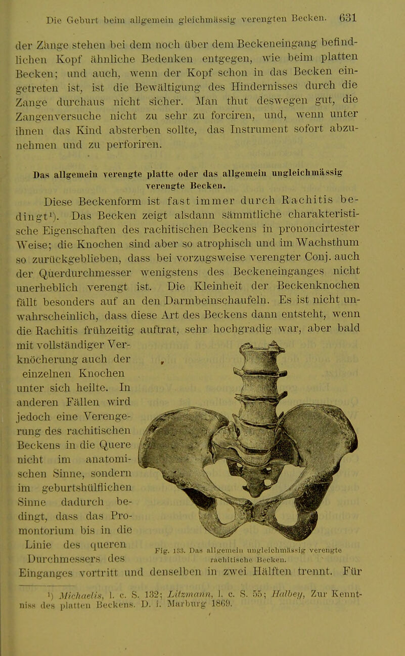 tier Zhnge stehen bei dem noeh iiber dem Beckeneing-ang befind- liehen Kopf ahnliehe Bedenken entgegeii, wie beim platten Becken; und audi, weiiii der Kopf schoii in das Becken ein- getreten ist, ist die Bewiiltigung des Hindernisses durch die Zange diirchaus nicht sicher. Man thut deswegen gut, die Zangenversuche nicht zu sehr zu forciren, und, wenn unter ihnen das Kind absterben sollte, das Instrument sofort abzu- nehmen und zu perforiren. Das allgemeiu vereugte platte oder das allgemein uiigfleiclniiassig- vereugte Beckeii. Diese Beckenform ist fast immer durch Rachitis be- dingt^). Das Becken zeigt alsdann sammthche charakteristi- sche Eigen«chaften des rachitischen Beckens in prononcirtester Weise; die Knochen sind aber so atrophisch und im Wachsthum so zuriickgebheben, dass bei vorzugsweise verengter Conj. auch der Querdurchmesser wenigstens des Beckeneinganges nicht unerheblich verengt ist. Die Kleinheit der Beckenknochen filllt besonders auf an den Darmbeinschaufehi. Es ist nicht un- wahrscheinlich, dass diese Art des Beckens dann entstelit, wenn die Rachitis friihzeitig auftrat, sehr hochgradig war, aber bald mit vollstandiger Ver- knocherung auch der einzelnen Knochen unter sich heilte. In anderen Fallen wird jedoch eine Verenge- rung des rachitischen Beckens in die Quere nicht im anatomi- schen Sinne, sondern im geburtshiilflichen Sinne dadurch be- dingt, dass das Pro- montorium bis in die Linie des queren Durchmessers des Einganges vortritt und denselben in zwei Halften trennt Fig. ia3. Das allKeirieiii uiifrleichmilsf'ig verengte racliitische Boclccn. Fiir 1) Michaelis, 1. c. S. 132; Lifzviann, I. c. S. 55; Halbei/, Ziir Keimt- iiiss ties platteii Beckens. D. i. Mnrljiug 1869.