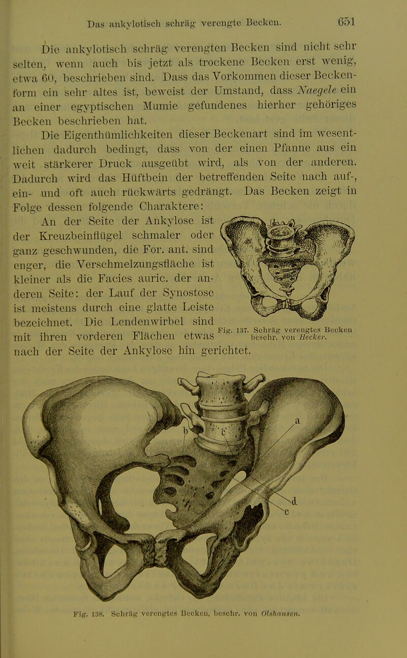 Die ankylotiscli schriig' verengtcn Becken sind niclit schr seltcn, wenn auch bis jetzt als trockene Beckon erst wenig, etwa 60, beschrieben sind. Dass das Vorkommen dieser Becken- form cin sehr altes ist, beweist der Umstand, dass Naegele ein an einer egyptischen Mumie gefundenes hierher gehoriges Becken beschrieben hat. Die Eigenthiimlichkeiten dieser Beckenart smd im wesent- lichen dadurch bedingt, dass von der einen Pfanne aus ein weit stiirkerer Druck ausgeilbt wird, als von der anderen. Dadurch wird das Htiftbein der betreffenden Seite nach auf-, ein- und oft auch rilckwarts gedrangt. Das Becken zeigt in Folge dessen folgende Charaktere: An der Seite der Ankylose ist der Kreuzbeinttiigel schmaler odor ganz geschwunden, die For. ant. sind enger, die Verschmelzungsflache ist kleiner als die Facies auric, der an- deren Seite: der Lauf der Synostose ist moistens durch eine glatto Leiste bezcichnet. Die Lendenwirbel sind , -i-ii.. 1 , Fig-. 137. Schi-ag verengtes Becken rait ihren vordoren J^lacnen etwas besciir. von i/ecfcer. nach der Seite der Ankylose hin gerichtet. Fig. 138. Schrllg vcrcngtcs Beckon, licschr. von Ohhauscn,