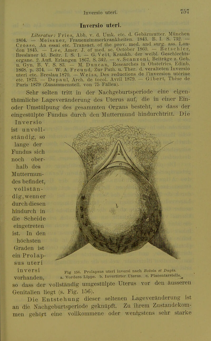 ' Inversio uteri. Liter at ur: Fries, Abli. v. d. Umk. etc. d. Gebarmutter. Miinchen 1804. — Meissner, Frauenziinmerkrankheiten. 1843. B. I. S. 732. — Crosse, An essai etc. Transact, of the pro v. med. and siirg-. ass. Lon- don 1845. — Lee, Amer. J. of med. sc. October 1860. — Betschler, Breslaner kl. Beitr. I. S. 1. — G. Veit, Krankh. der weibl. Geschlechts- organe. 2. Aiifl. Erlangen 1867. S. 342. — v. Scanzoni, Beitrage z. Geb. n. Gvn. B. V. S. 83. — M. Dxmcan, Researches in Obstetrics. Edinb. 1868. p. 374. — W. A. Frennd, Znr Path. u. Ther. d. veralteten Inversio uteri etc. Breslau 1870. —Weiss, Des reductions de I'inversion uterine etc. 1873..— Depaul, Arch, de tocol. Avril 1879. — Gibert, These de Paris 1879 (Zusammenstell. von 75 Fallen). Sehr selten tritt in der Nachgeburtsperiode eine eigen- thumliche Lageveranderung des Uterus auf, die in einer Ein- oder Umsttilpung des gesammten Organs besteht, so dass der eingestiilpte Fundus durcli den Muttermund liindurchtritt. Die Inversio ist unvoll- standig, so lange der Fundus sich noch ober- halb des Muttermun- des befindet, vollstan- dig,wenner durch diesen hindurch in die Scheide eingetreten ist. In den hochsten Graden ist ein Prolap- sus uteri Fig 156. Prolapsus uteri iuversi nacli Boivin et Diig&s. a. Vordere. Llppe. b. Invertirter Uterus, c. Placeutarstelle^ mversi vorhanden, so dass der vollstandig umgestiilpte Uterus vor den ausseren Genitalien liegt (s. Fig. 156). Die Entstehung dieser seltenen Lageveranderung ist an die Nachgeburtspcriode gekniipft. Zu ihrem Zustandekom- men gehort eine vollkommeue oder wenigstens sehr starke