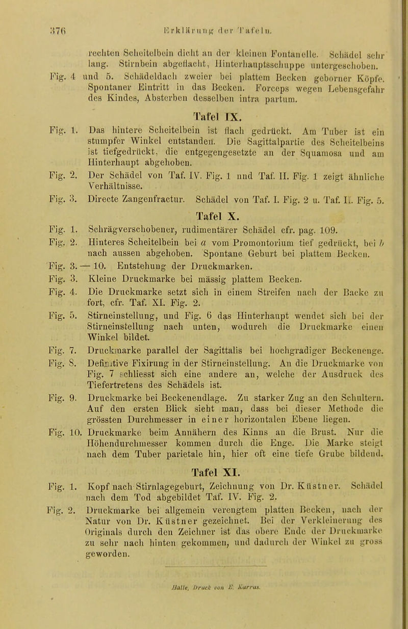 roclitüii Scliüilolbcin dicht an der kleinen Fontanelle. Schädel sehr lang. Stirnbein ab{>ellacht, llinterhauptsscliuppe untergebchoben, Fig. 4 und 5. Schädeldach zweier bei plattein Becken gcborner Köpfe. Spontaner Eintritt in das Becken. Forceps wegen Lebensgefahr des Kindes, Absterben desselben intra partum. ^Pafel IX. Fig. 1. Das hintere Scheitelbein ist llach gedrückt. Am Tuber ist ein stumpfer Winkel entstanden. Die Sagittalpartie des Scheitelbeins ist tiefgedrtickt, die entgegengesetzte an der Squamosa und am Hinterhaupt abgehoben. Fig. 2. Der Schädel von Taf. IV. Fig. 1 und Taf. II. Fig. 1 zeigt ähnliche Verhältnisse. Fig. 3. Directe Zangenfractur. Schädel von Taf. I. Fig. 2 u. Taf. II. Fig. 5. Tafel X. Fig. 1. Schrägverschobener, rudimentärer Schädel cfr. pag. 109. Fig. 2. Hinteres Scheitelbein bei a vom Promontorium tief gedrückt, bei // nach aussen abgehoben. Spontane Geburt bei plattem Becken. Flg. 3. — 10. Entstehung der Druckmarken. Fig. 3. Kleine Druckmarke bei mässig plattem Becken. Fig. 4. Die Druckmarke setzt sich in einem Streifen nach der Backe zu fort, cfr. Taf. XI. Fig. 2. Fig. 5. Stirneinstellung, und Fig. 6 das Hinterhaupt wendet sich bei der Stirneinstellung nach unten, wodurch die Druckmarke einen Winkpl bildet. Fig. 7. Druckmarke parallel der Sagittalis bei hochgradiger Beckenenge. Fig. S. Definitive Fixirung in der Stirneinstellung. An die Druckmarke von Fig. 7 fchliesst sich eine andere an, welche der Ausdruck des Tiefertretens des Schädels ist. Fig. 9. Druclvmarlce bei Beckenendlage. Zu starker Zug an den Schultern. Auf den ersten Blick sieht man, dass bei dieser Methode die grössten Durchmesser in einer horizontalen Ebene liegen. Fig. 10. Druckmarke beim Annähern des Kinns an die Brust. Nur die Ilöhendurchuiesser kommen durch die Enge. Die Marke steigt nach dem Tuber parietale hin, hier oft eine tiefe Grube bildend. Tafel XI. Fig. 1. Kopf nach Stirnlagegeburt, Zeichnung von Dr. Küstner. Schädel nach dem Tod abgebildet Taf. IV. Fig. 2. Fig. 2. Druckmarke bei allgemein verengtem platten Becken, nach der Natur von Dr. Küstner gezeichnet. Bei der Verkleinerung des Originals durch den Zeichner ist das obere Ende der Druckmarke zu sehr nach hinten gekommen, und dadurch der Winkel zu gross geworden. JlaUe. brück von i'. Karras.