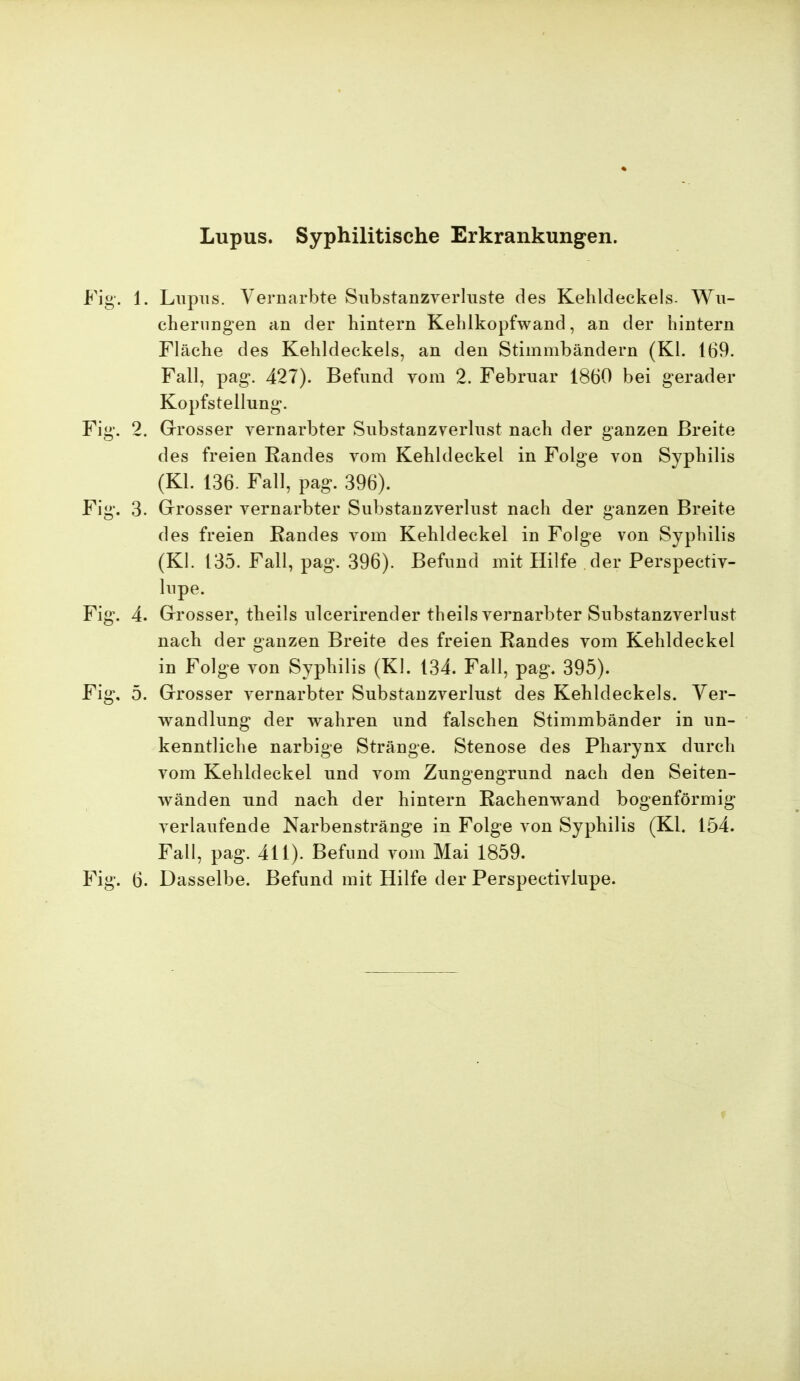 Fig. 1. Lupus. Vernarbte Substanzverluste des Kehldeckels. Wu- cherungen an der hintern Kehlkopfwand, an der hintern Fläche des Kehldeckels, an den Stimmbändern (Kl. 169. Fall, pag. 427). Befund vom 2. Februar 1860 bei gerader Kopfstellung. Fig. 2. Grosser vernarbter Substanzverlust nach der ganzen Breite des freien Randes vom Kehldeckel in Folge von Syphilis (Kl. 136. Fall, pag. 396). Fig. 3. Grosser vernarbter Substanzverlust nach der ganzen Breite des freien Randes vom Kehldeckel in Folge von Syphilis (Kl. 135. Fall, pag. 396). Befund mit Hilfe der Perspectiv- lupe. Fig. 4. Grosser, theils ulcerirender theils vernarbter Substanzverlust nach der ganzen Breite des freien Randes vom Kehldeckel in Folge von Syphilis (Kl. 134. Fall, pag. 395). Fig, 5. Grosser vernarbter Substanzverlust des Kehldeckels. Ver- wandlung der wahren und falschen Stimmbänder in un- kenntliche narbige Stränge. Stenose des Pharynx durch vom Kehldeckel und vom Zungengrund nach den Seiten- wänden und nach der hintern Rachenwand bogenförmig verlaufende Narbenstränge in Folge von Syphilis (Kl. 154. Fall, pag. 411). Befund vom Mai 1859. Fig. 6. Dasselbe. Befund mit Hilfe der Perspectivlupe.
