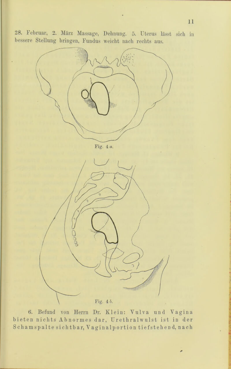 28. Febrimr, 2. März ]\Iass;igo, bessere Stellung bringen, Fniidns Dehnnug. 5. Uterus lässt sieh in weicht nach rechts ans. 6. Befund von Herrn Dr. Klein: V n 1 v a und Vagina bieten nichts Abnormes dar, Urethralwnlst ist in der Schamspalte sichtbar, Vaginalportion tiefstehend, nach